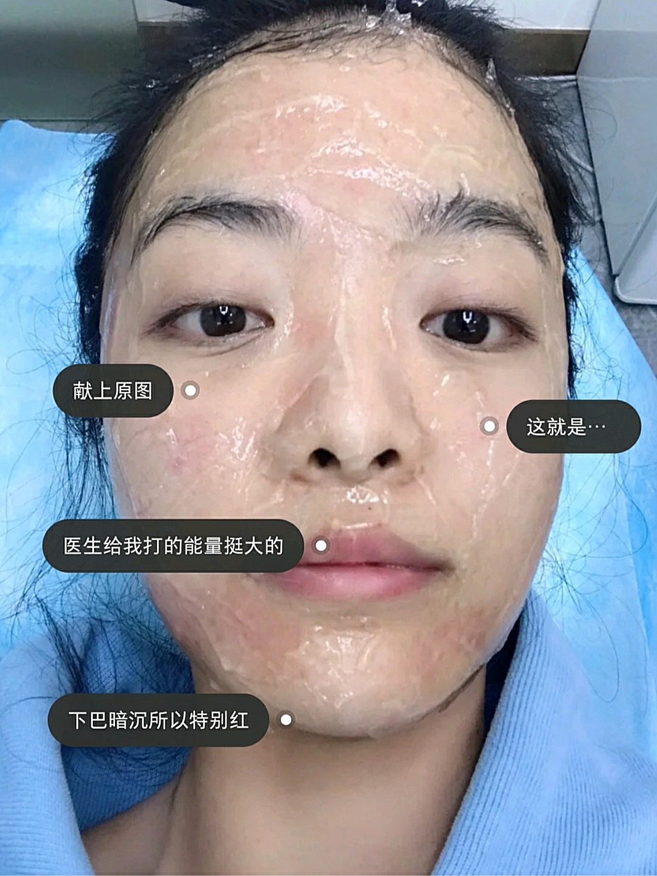 新鲜热乎的光子嫩肤反馈来啦75做了好久的功课真诚分享