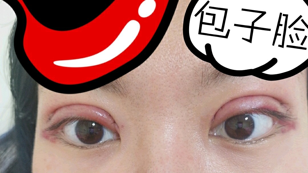 切开双眼皮第二天严重肿胀右眼眼尾位置睁开没有双眼皮褶皱只有刀口和