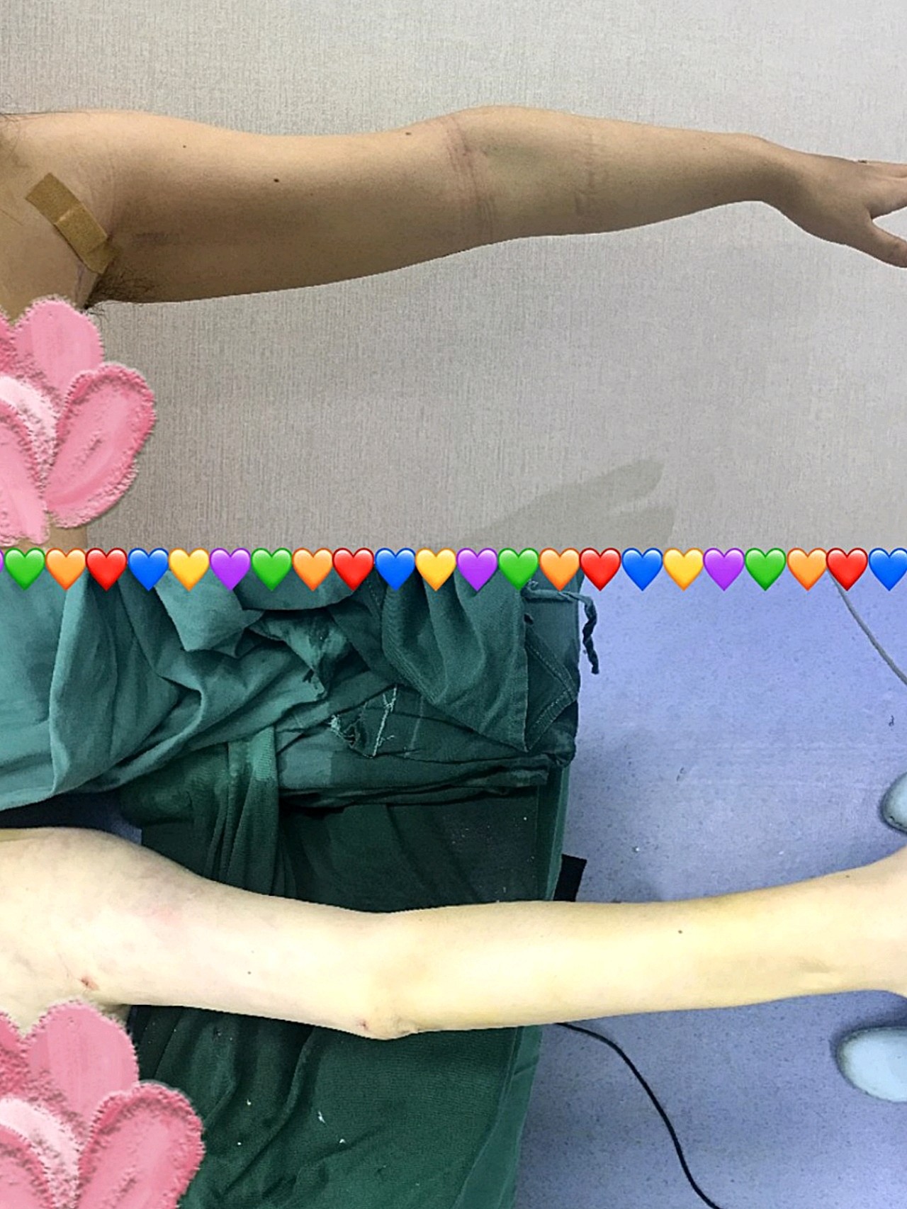 手臂吸脂比起大腿或者腰腹来说创伤还是比较小的,所以恢复起来也比较