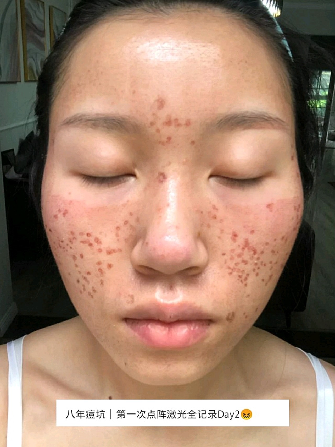 八年痘坑第一次点阵激光全记录day22