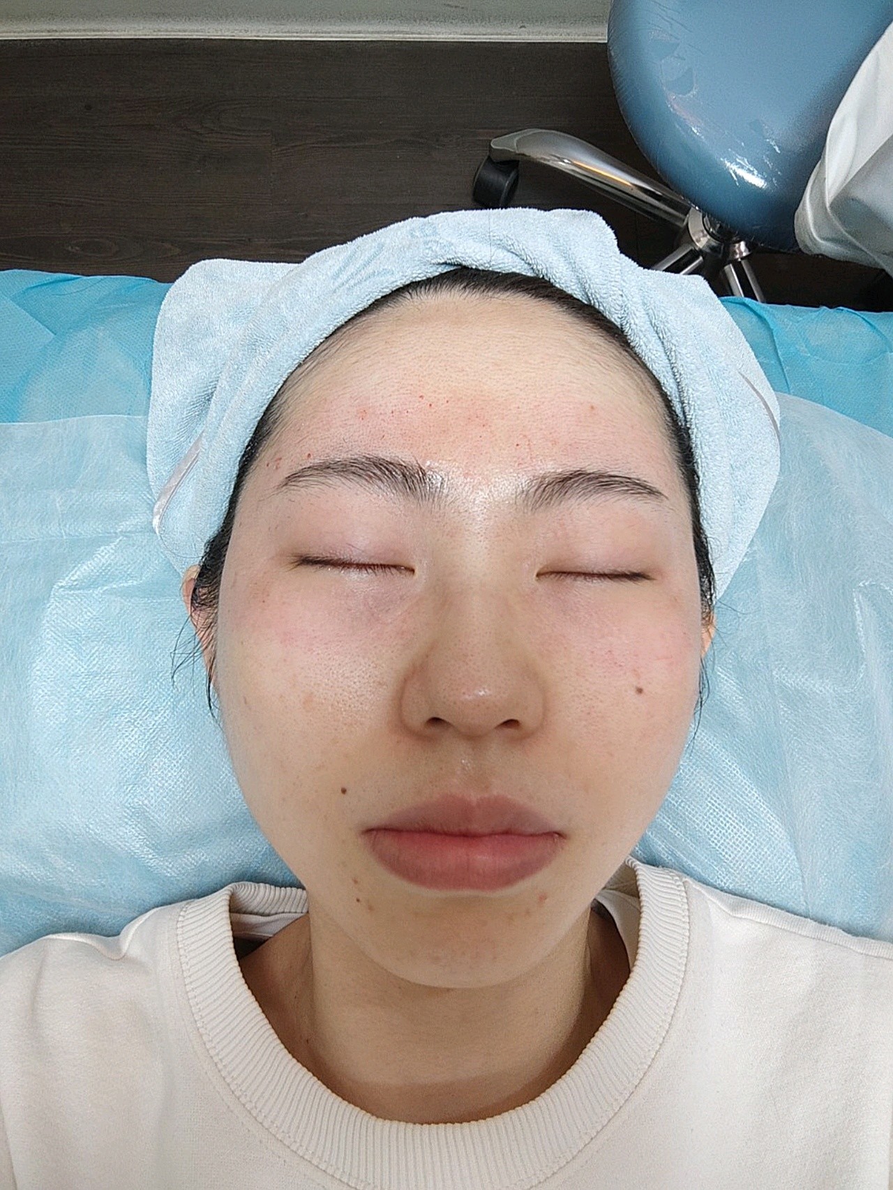 试用官 黄金微针感谢羊爸爸给我机会体验眼部黄金微_圈子-新氧美容