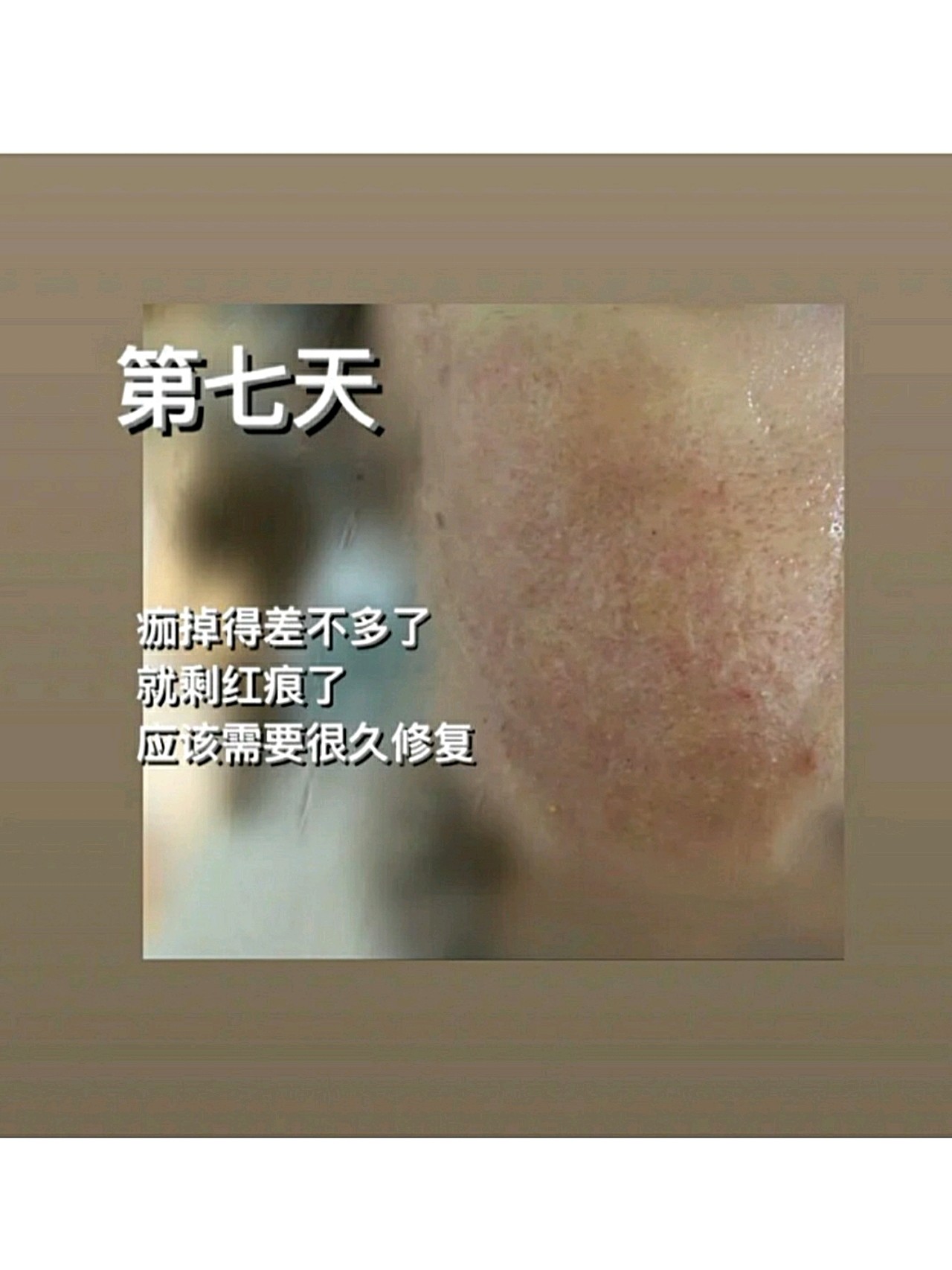 二氧化碳剝脫式點陣激光全記錄