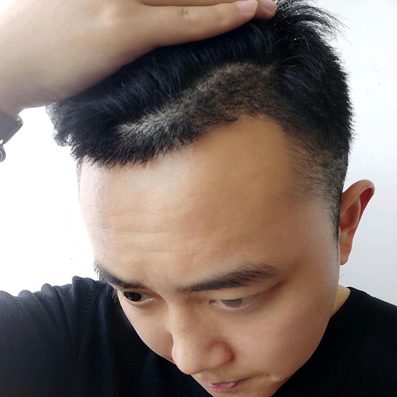 今天刚刚三十天,两个鬓角那里,感觉进入了脱落期,又_圈子-新氧美容