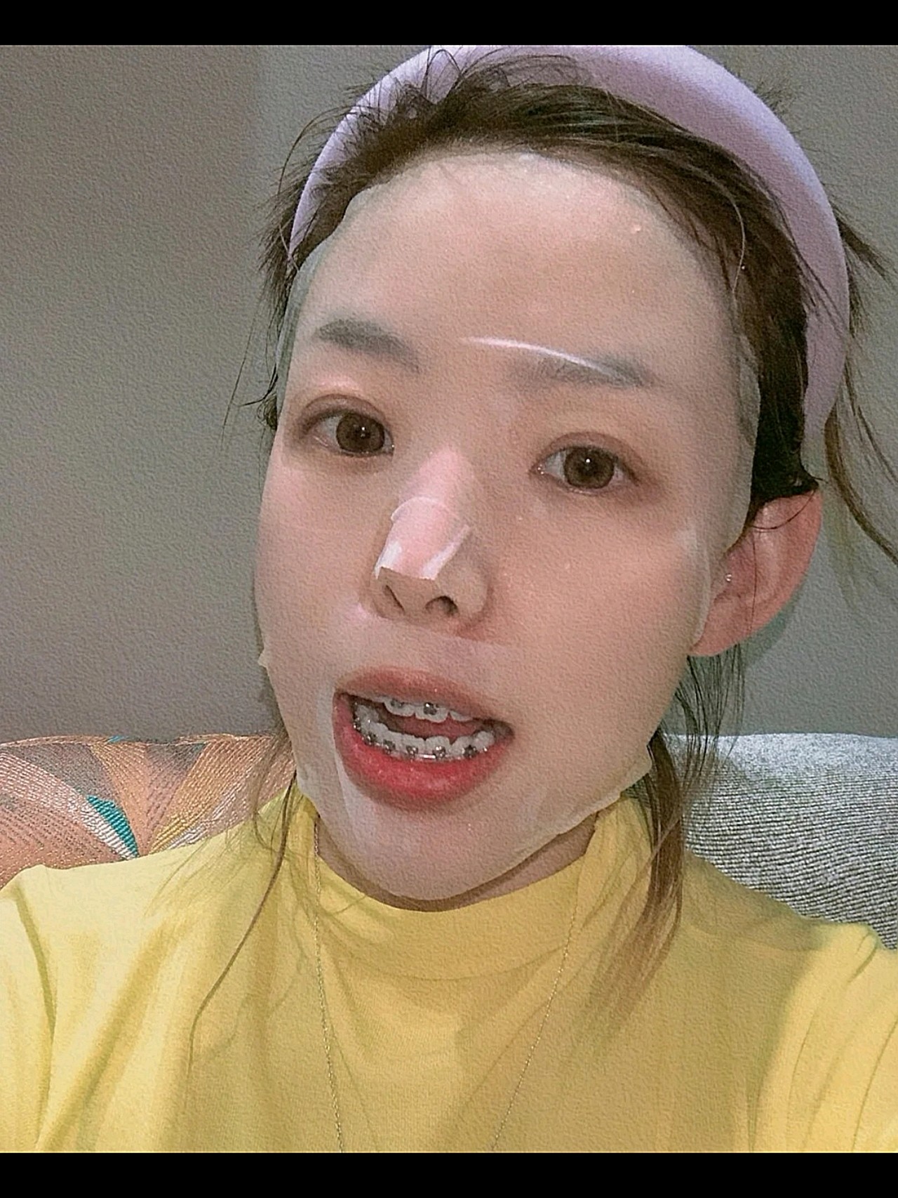 我的牙齿属于闭嘴看起来不太严重,侧面也还好,有下巴_圈子-新氧美容