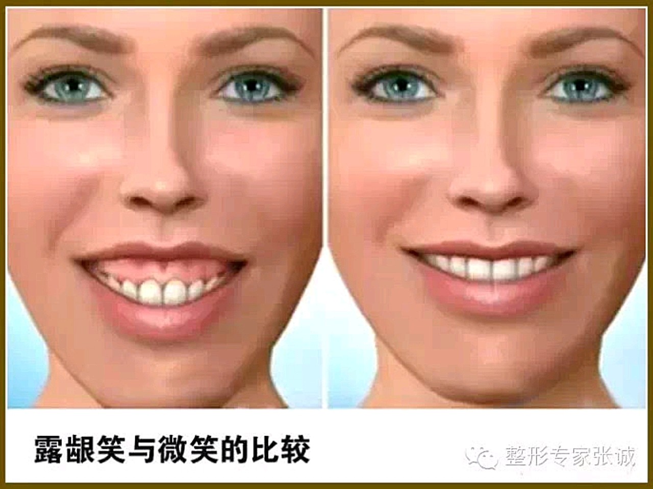 在露龈笑的人群中,微笑时上唇外翻现象严重,这类人群最佳的治疗方式是