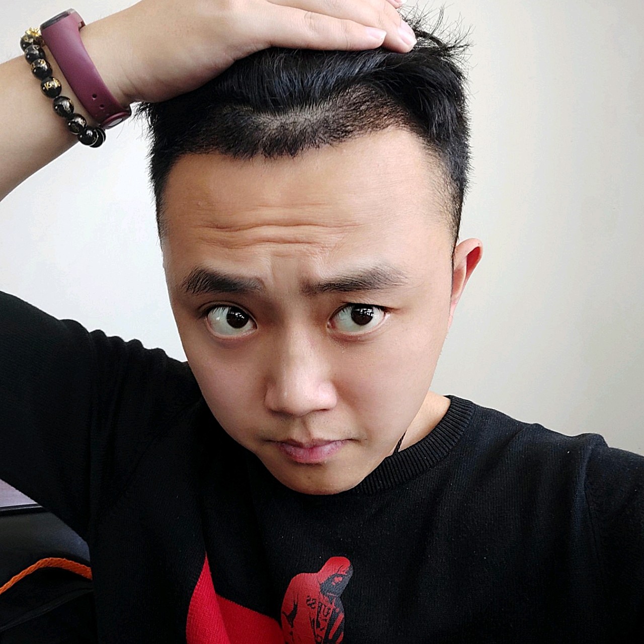 今天刚刚三十天,两个鬓角那里,感觉进入了脱落期,又_圈子-新氧美容