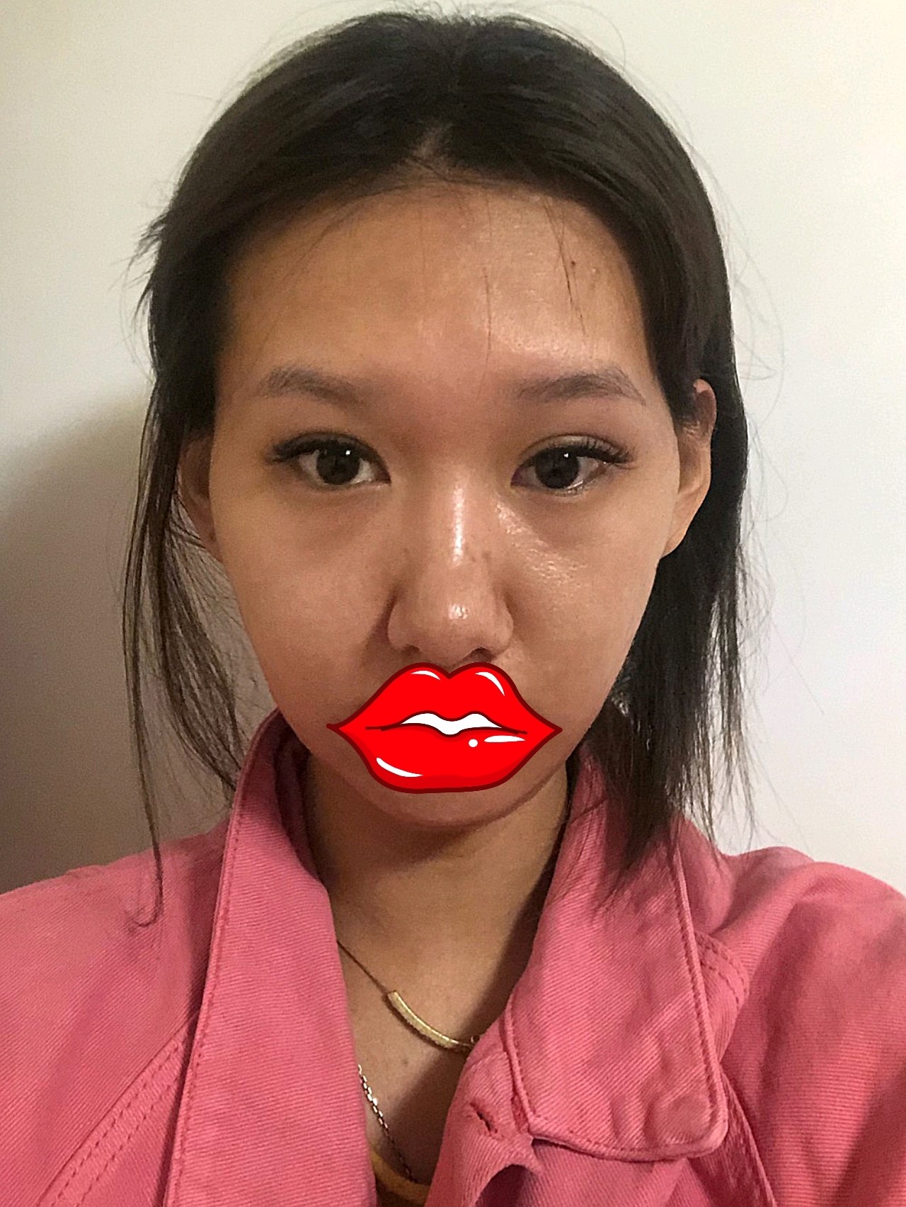 我的脸面部很干瘪,太阳穴啊,泪沟好几个地方都凹陷,考虑了很久决定做