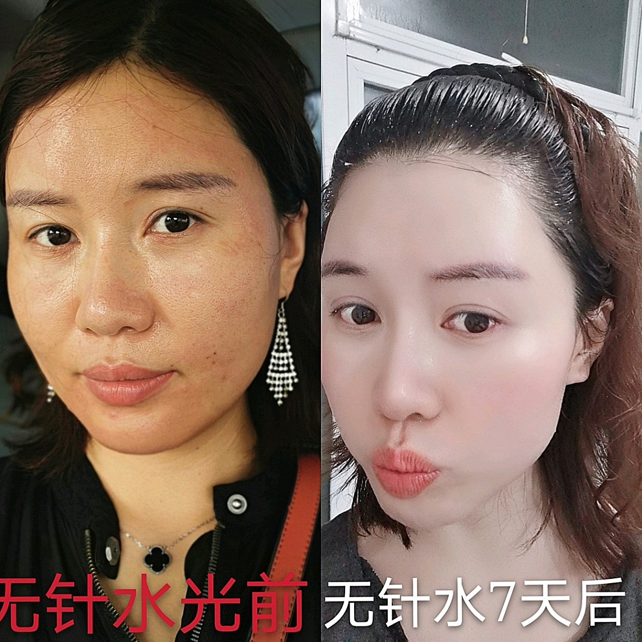 无针水光 效果棒棒哒