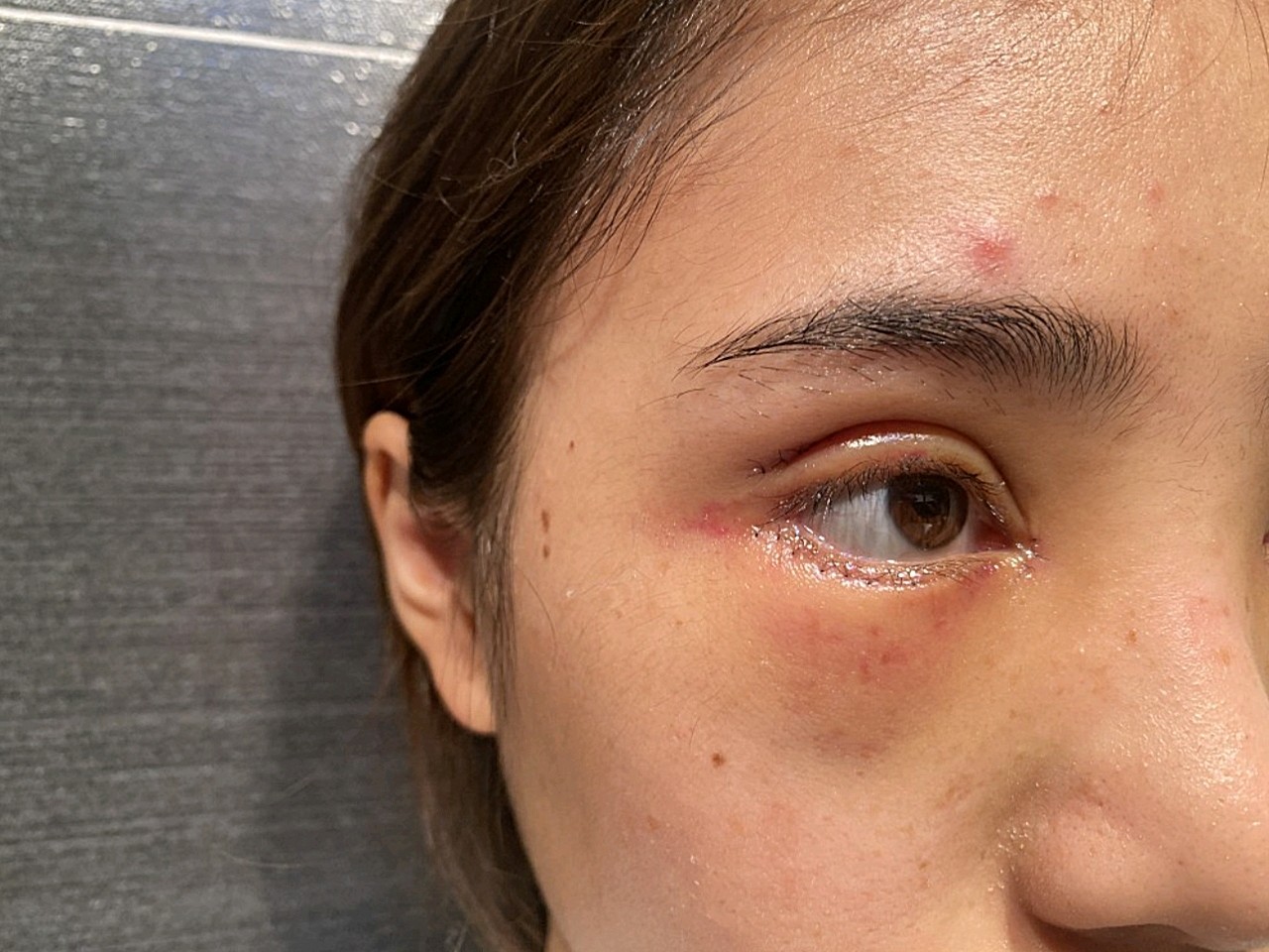 术后1天 今天眼睛是很肿胀的,昨天刚做完的时候还有些红,现在红散了
