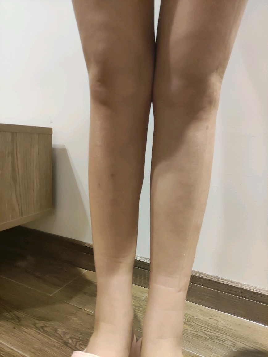 膝盖凹陷图片