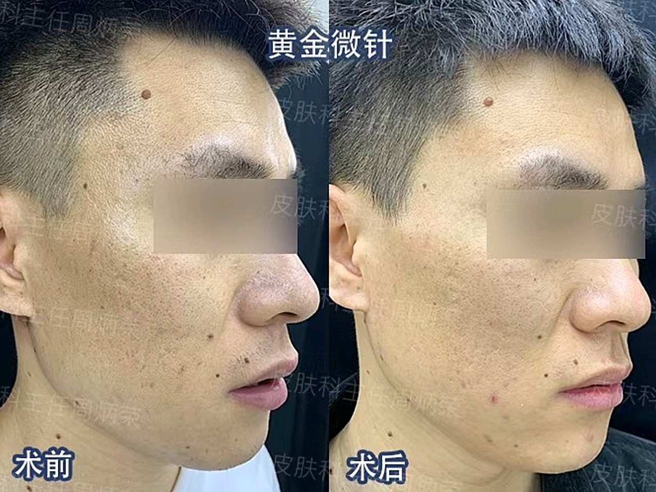 黄金微针治疗对比分享