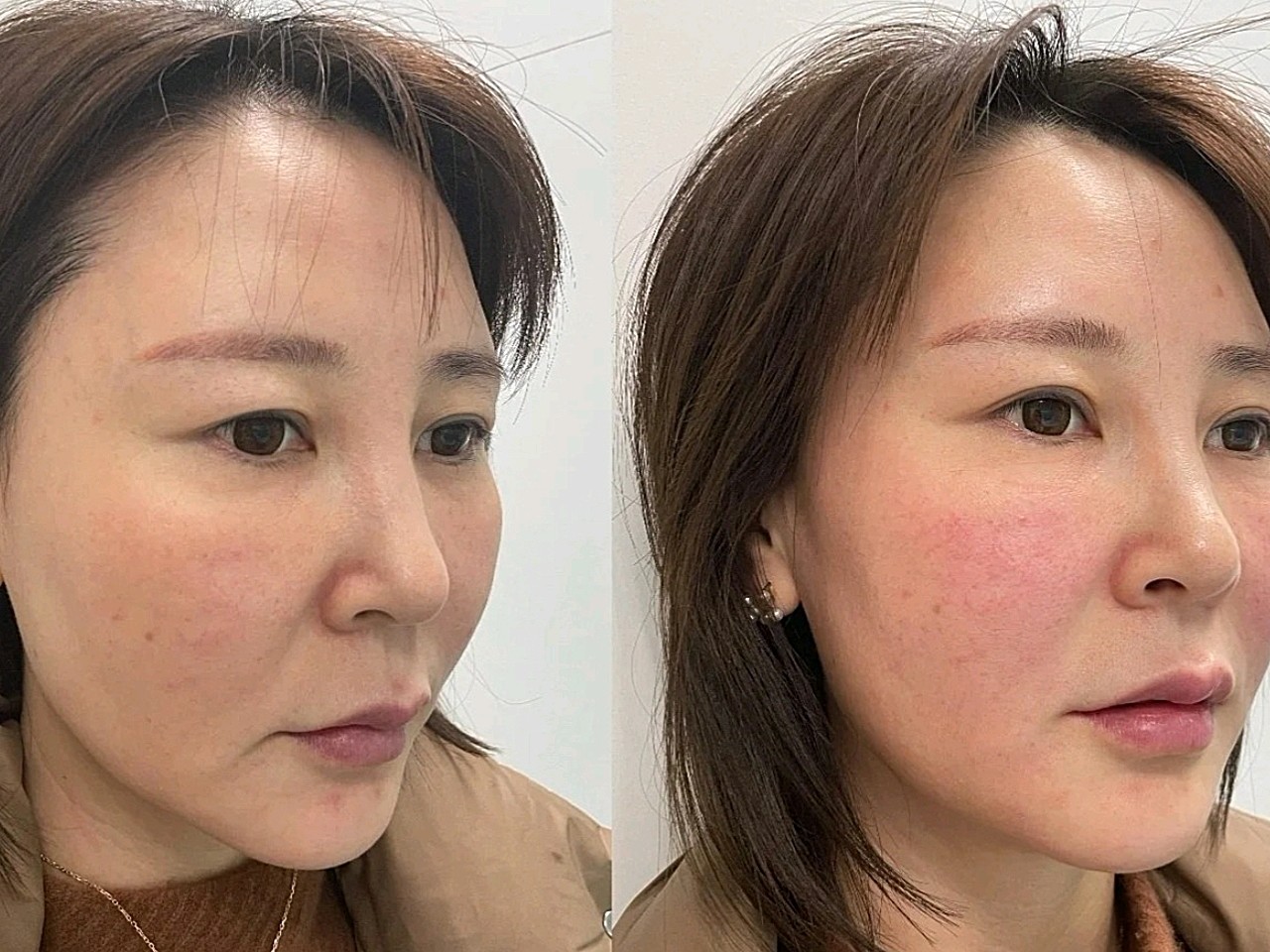 【杭州美天美热玛吉的体验】