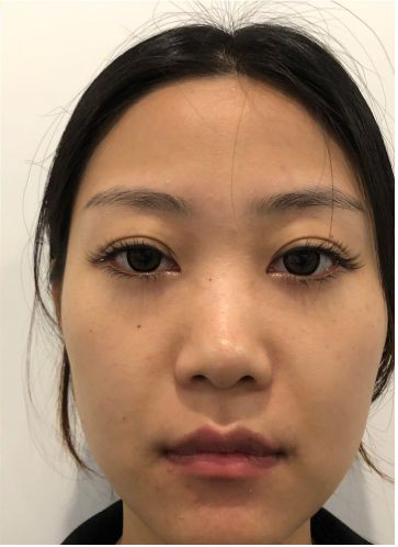 看看现在这个优秀又好看的小鼻子,真的是很让我爱的不_圈子-新氧美容