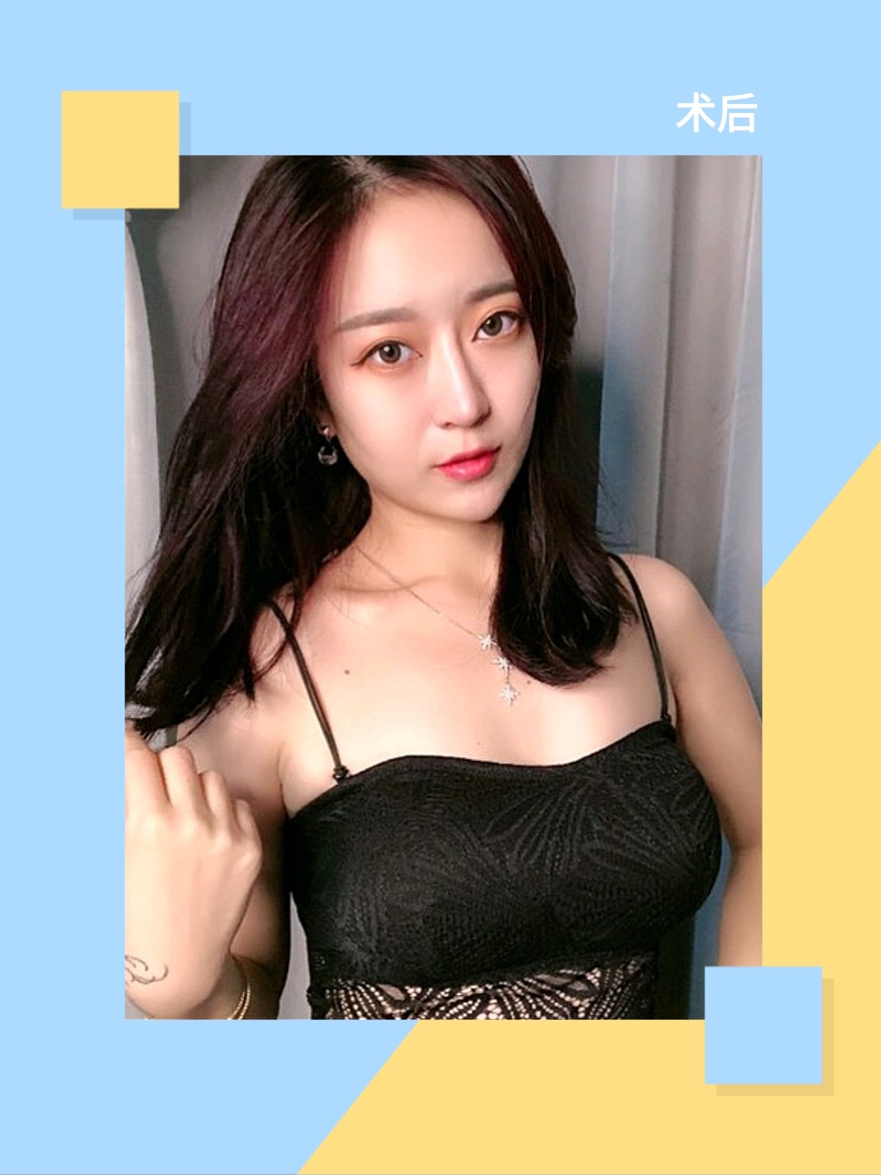 0606术前分析:这位小姐姐对于胸部一直不是很满意,她_圈子-新氧