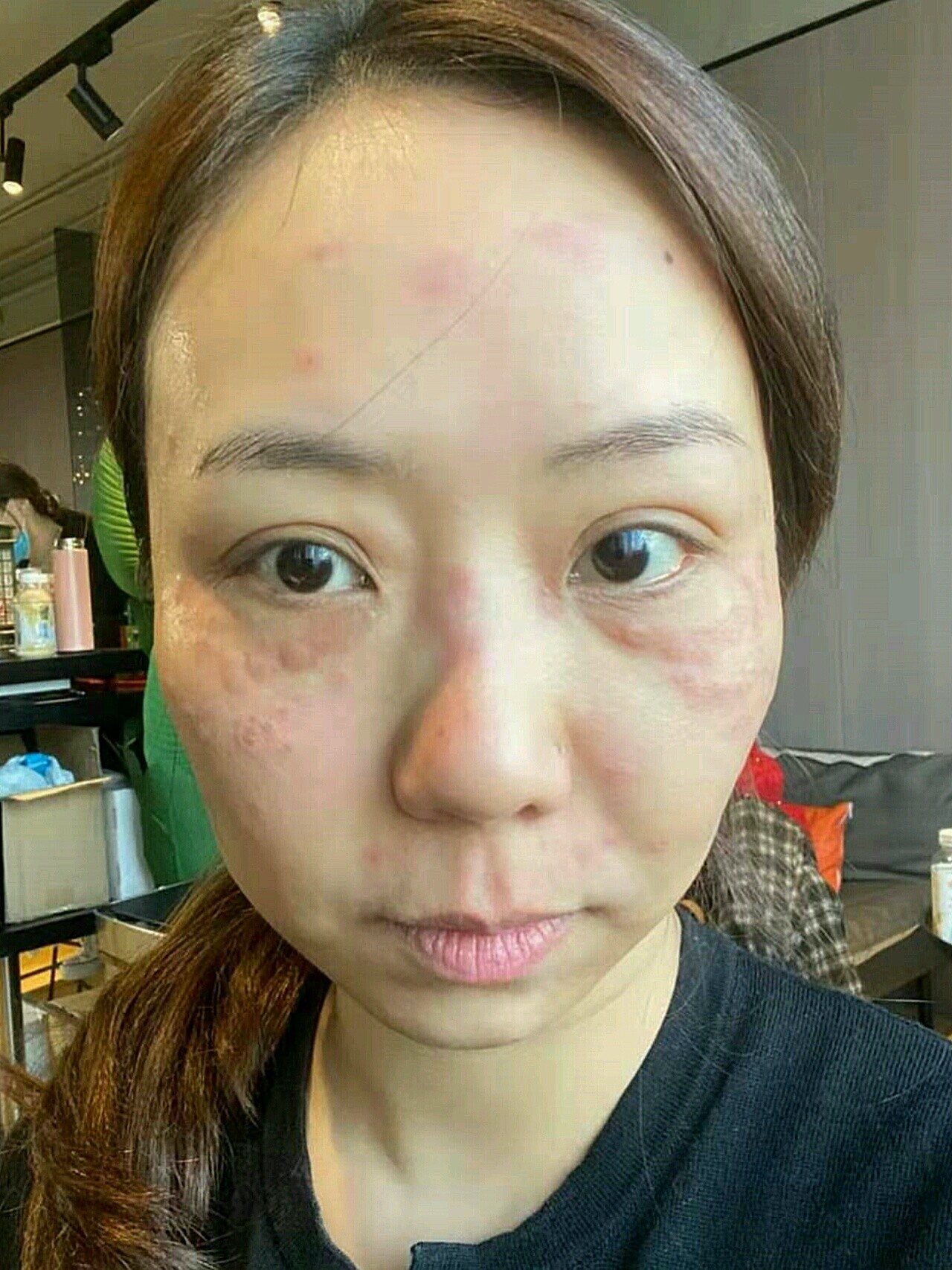 脸上一直有混合斑,雀斑为主,还有一些妊辰斑,蠢蠢欲_圈子-新氧美容