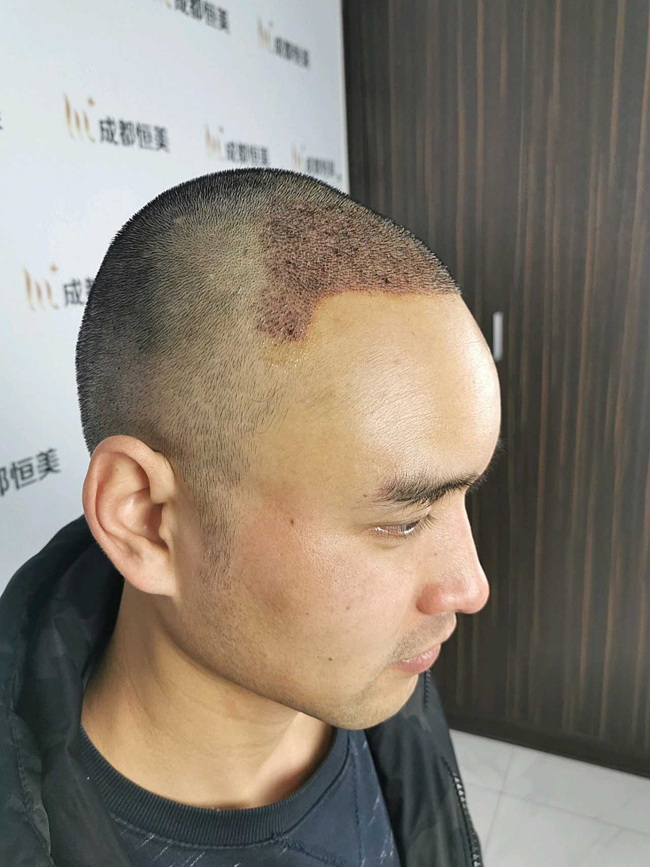 今天是植发手术后第4天,也算是术后第一次给你分享吧_圈子-新氧美容