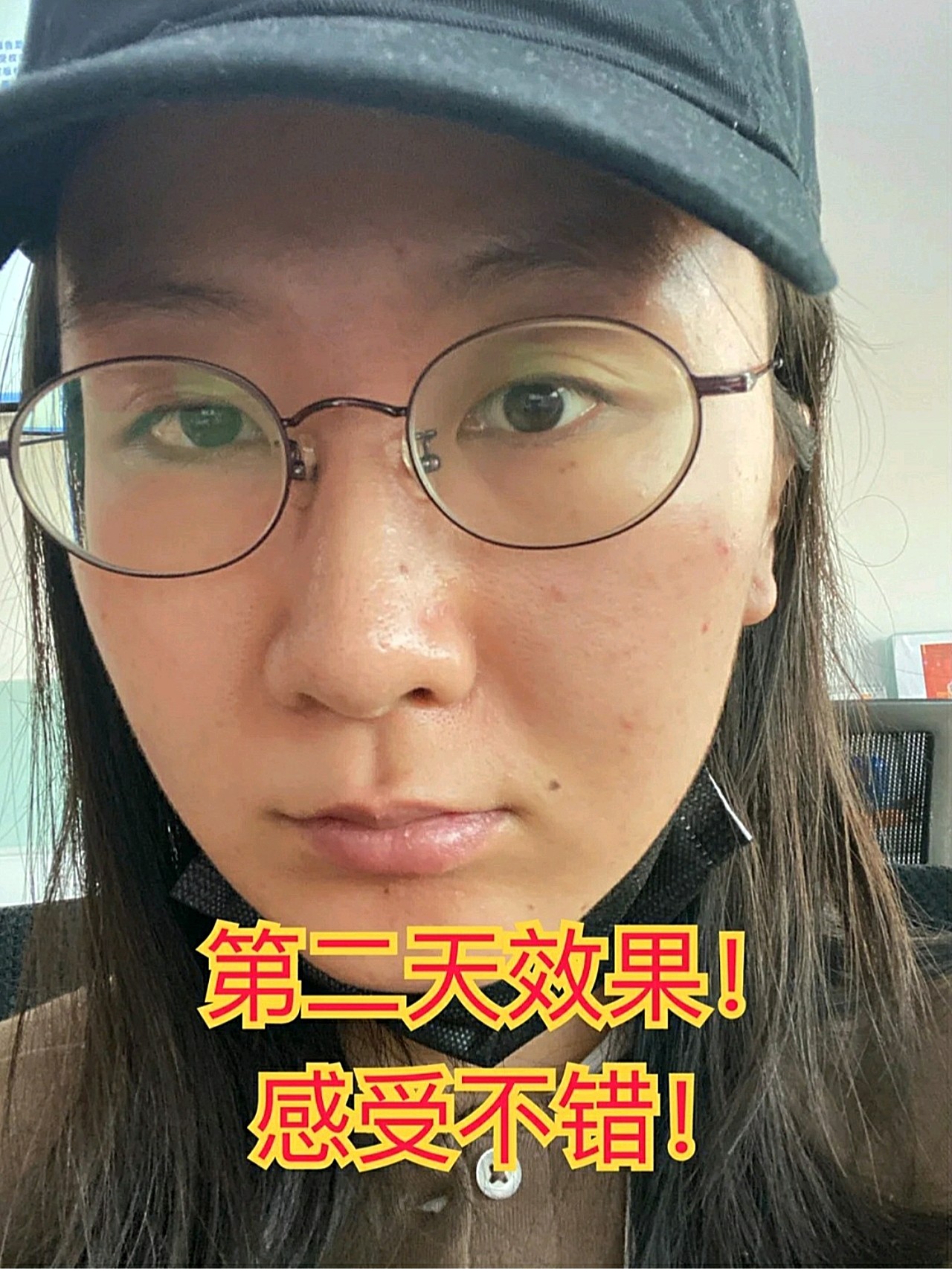 我做了人生第一次果酸焕肤75经验