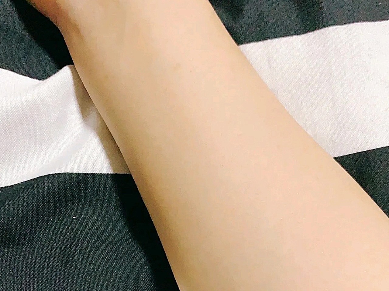 做的小手臂脱毛,两个手臂都做了,脱的还算干净,医生_圈子-新氧美容