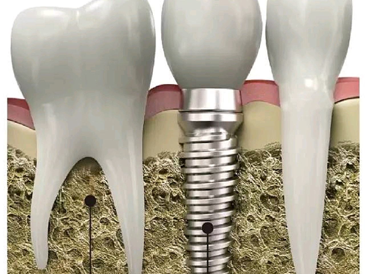 种植牙就是在牙床上植入一个人工金属牙根,待牙根与牙