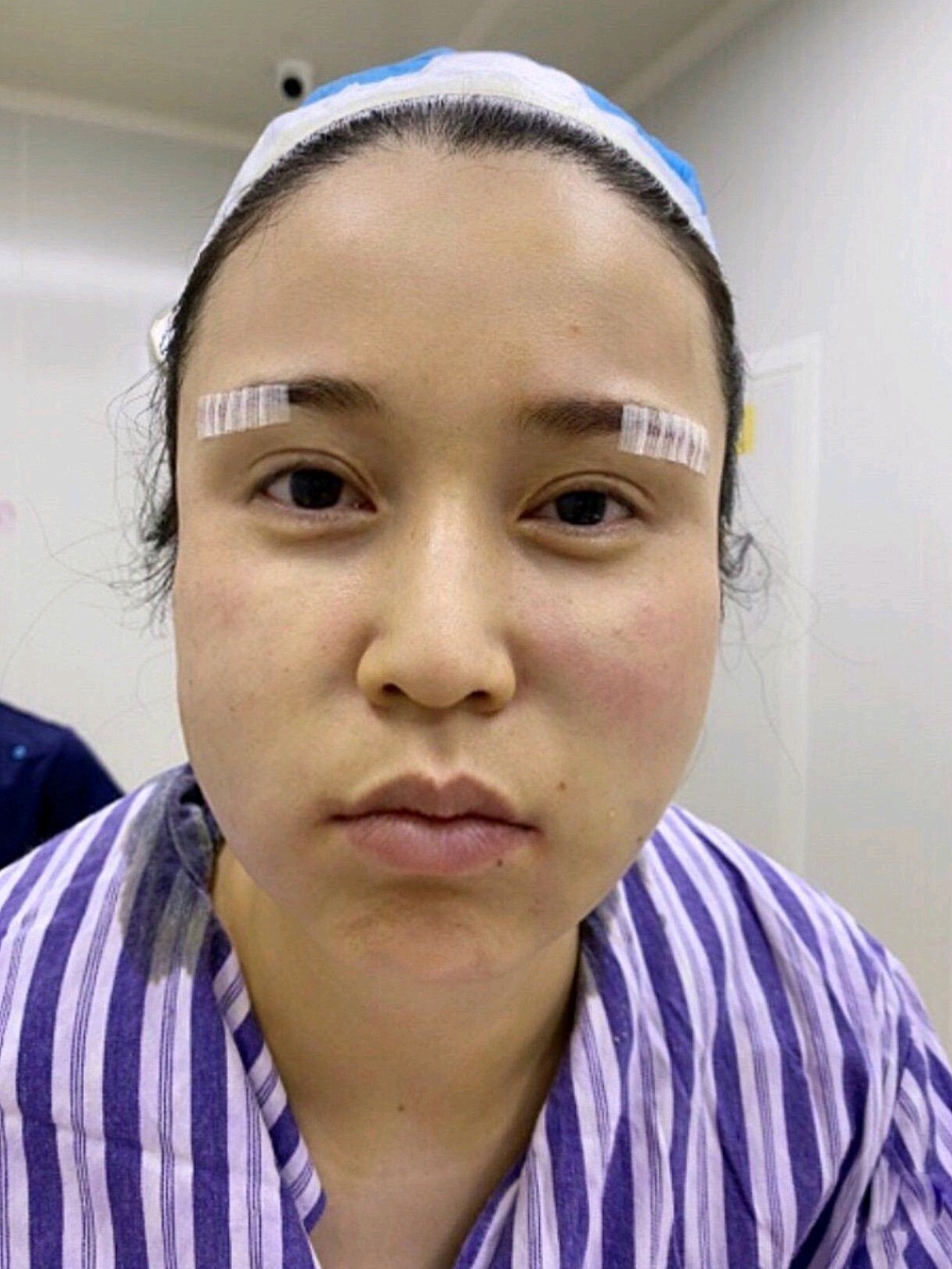 眉上提手术_提眉手术恢复过程图_眉毛手术