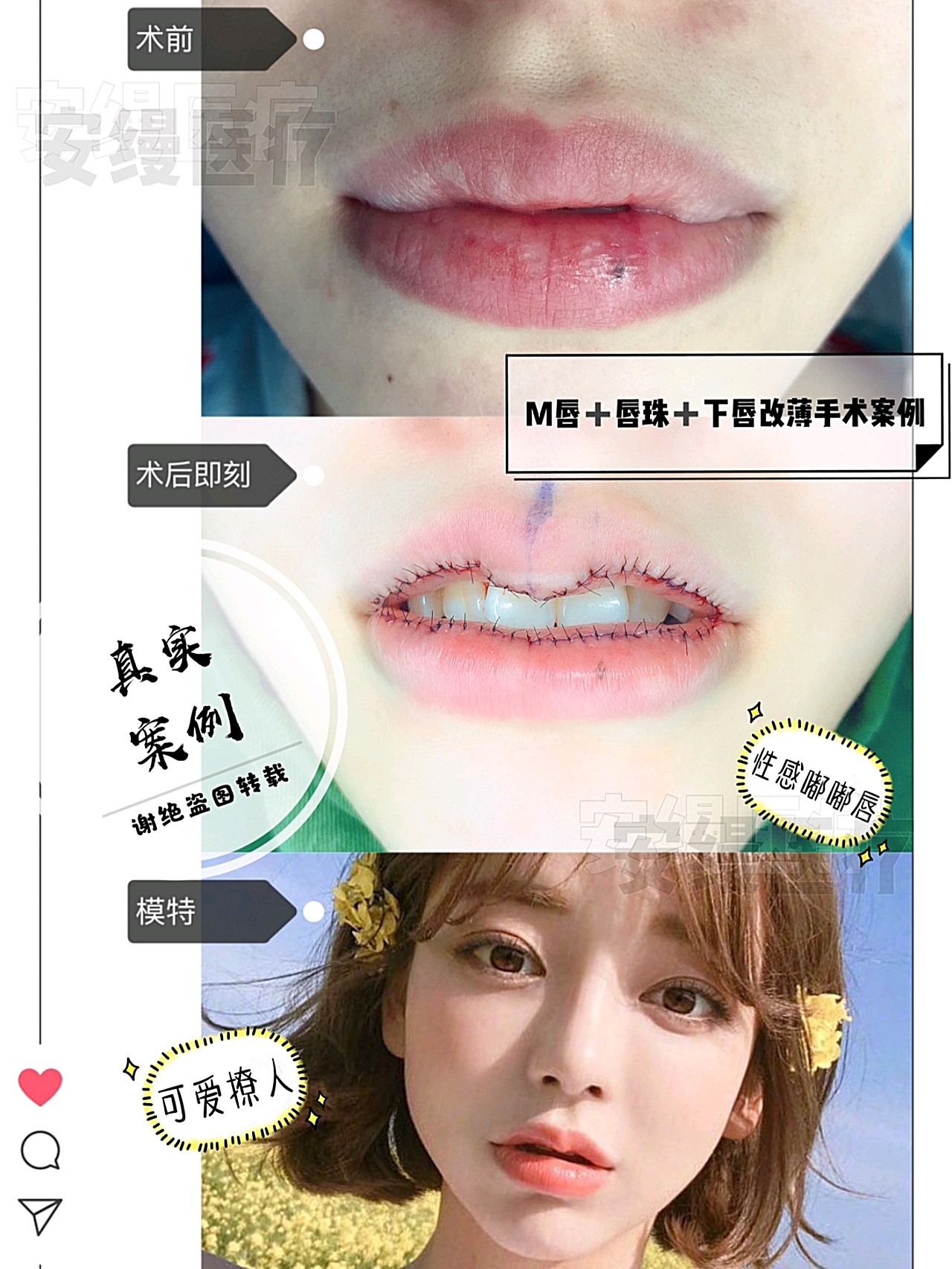 m唇唇珠下唇改薄手术案例