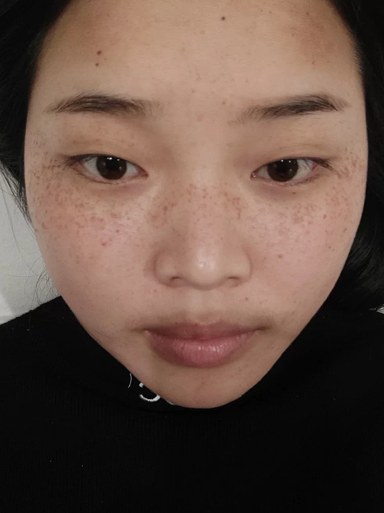 【雀斑是如何形成的?】