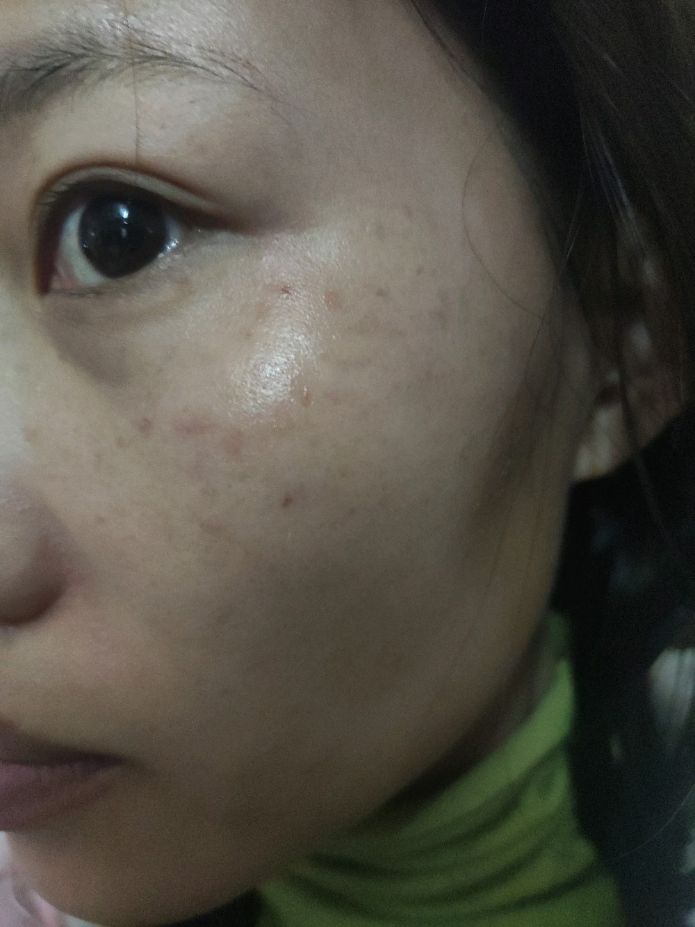 原来斑点的位置出现片小状发红