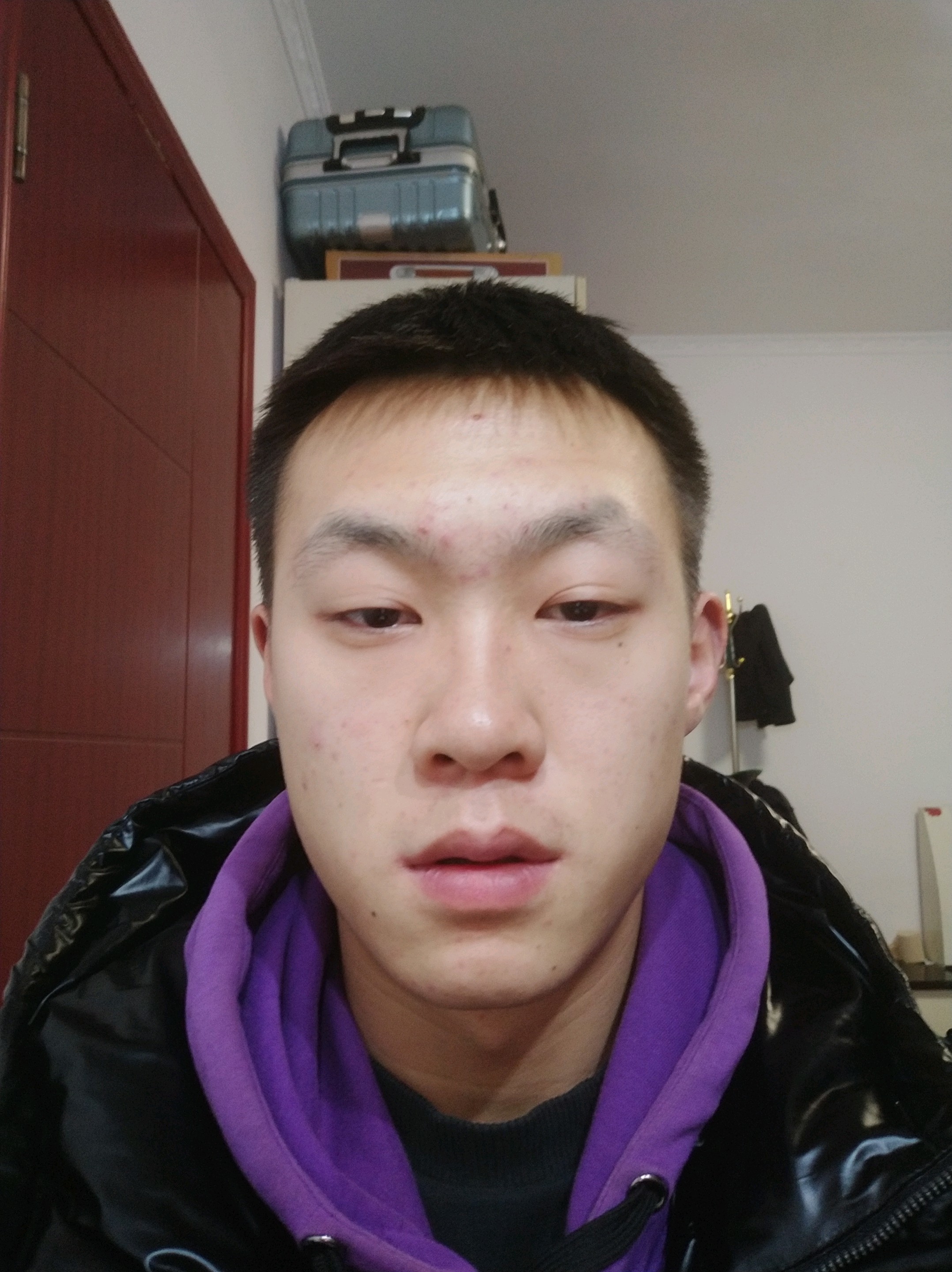 右脸浮肿两边脸不对称感觉脸是歪的