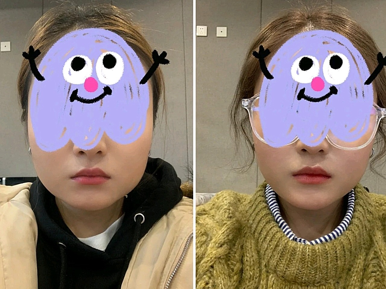 【沈阳汇美人瘦脸针术后15天】