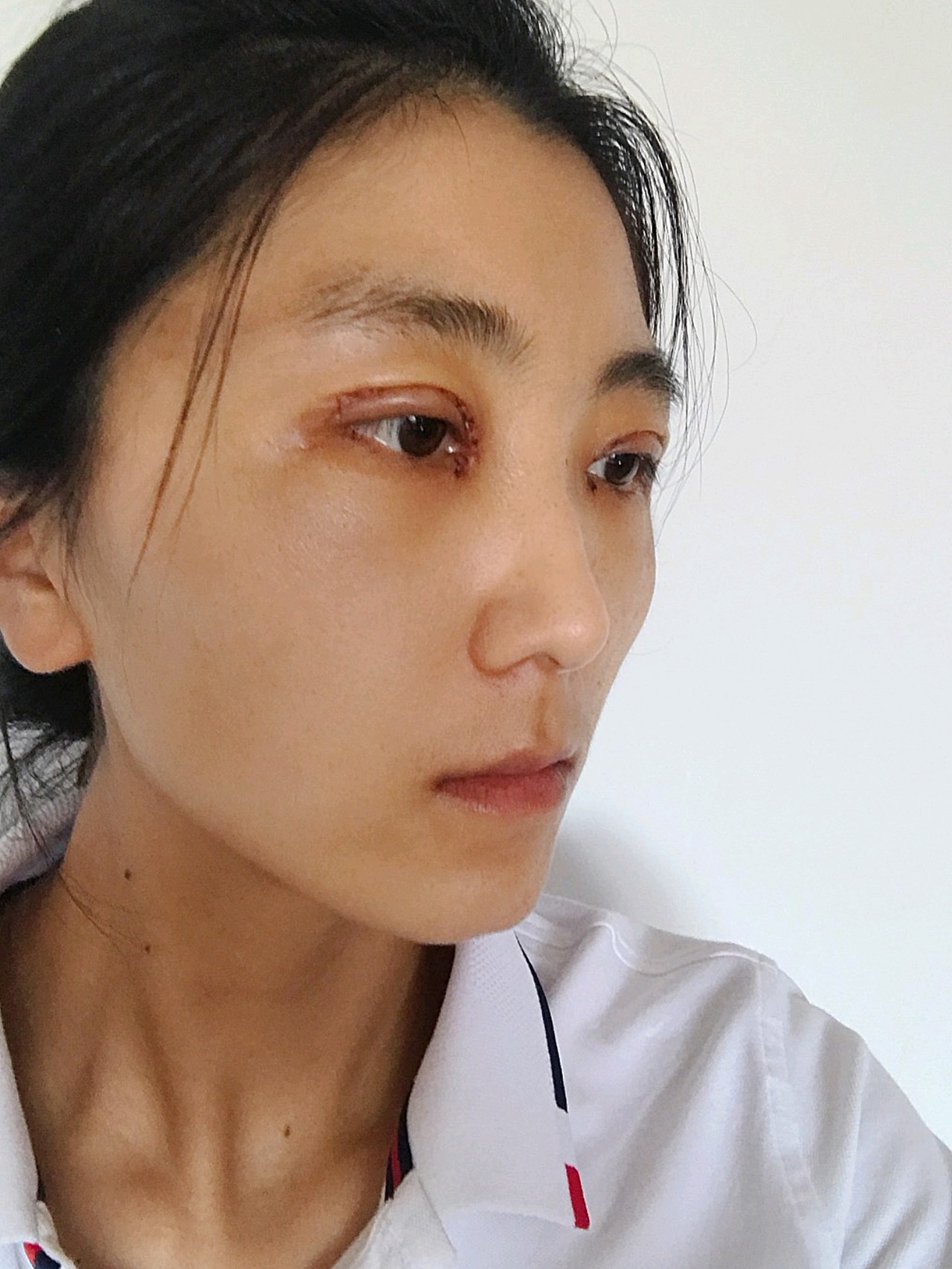 感觉我的眼睛消肿还是比较快的