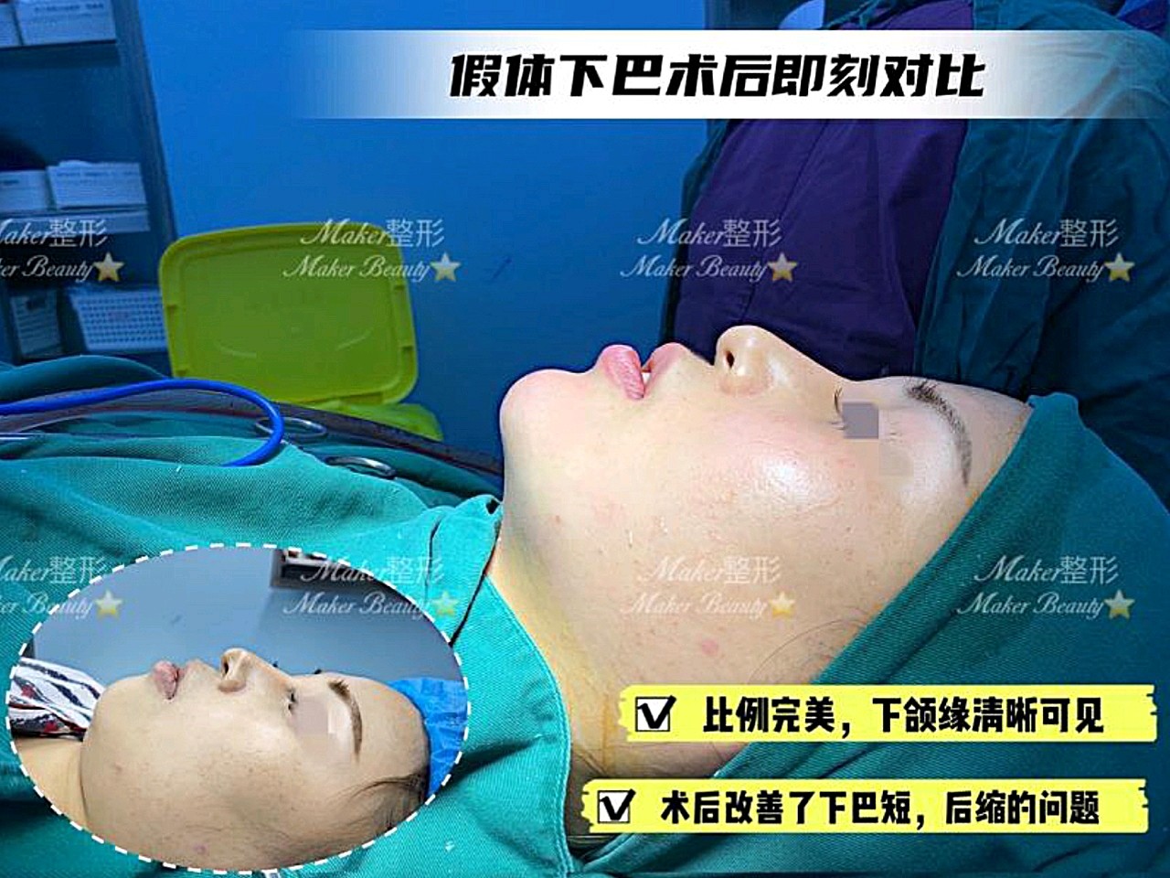 假体下巴术后即刻对比