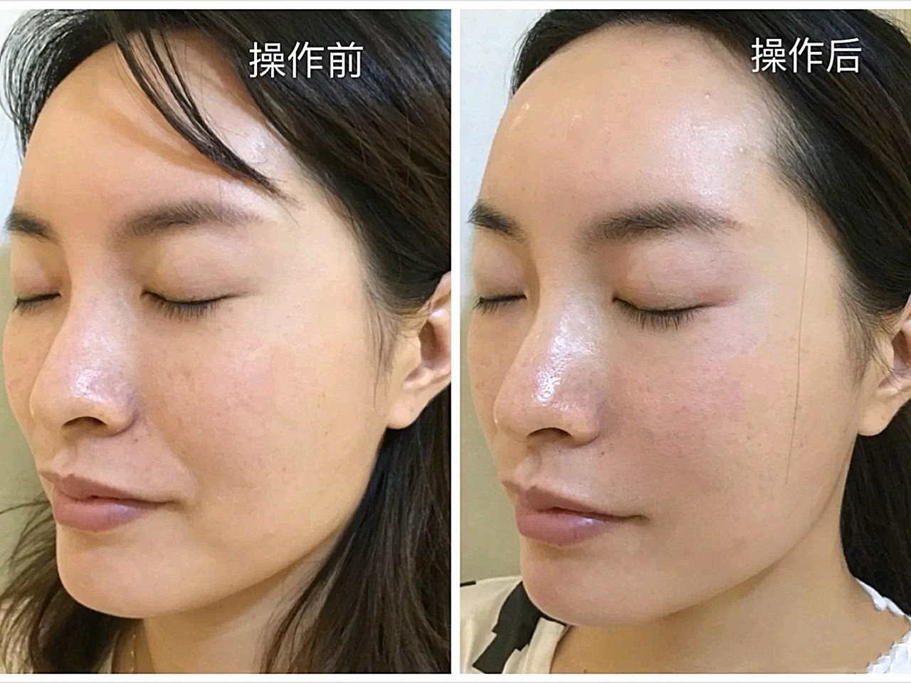 第一次体验热玛吉,因为脸比较肉,所以脸很容易下垂.