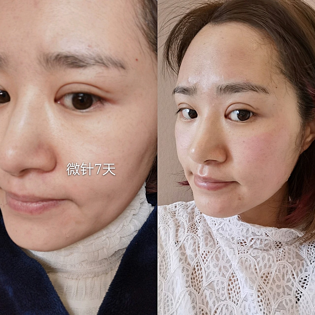 来给大家分享一下做完微针一个星期的效果,上面是_圈子-新氧美容整形