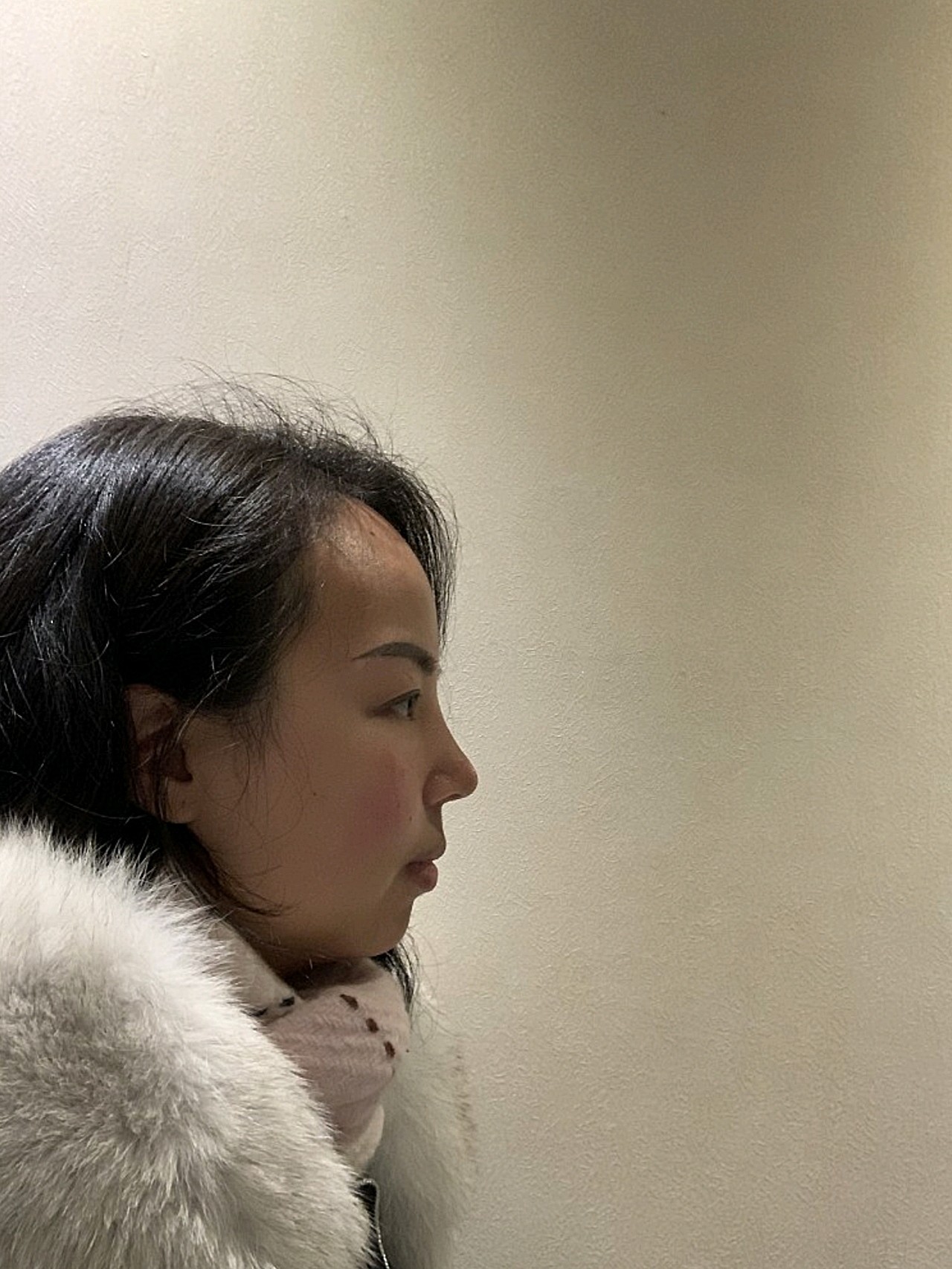 侧脸轮廓升级的感觉,瞬间就变得好看了很多,山根和额头的衔接做得还不