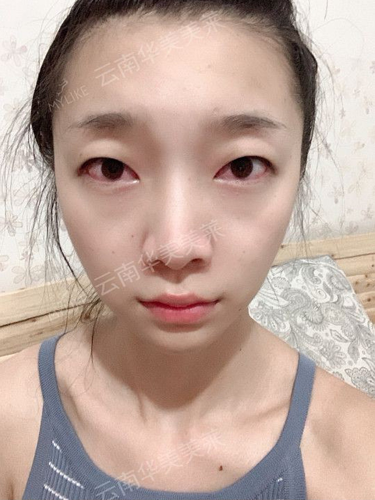 内双肿泡眼,内眦