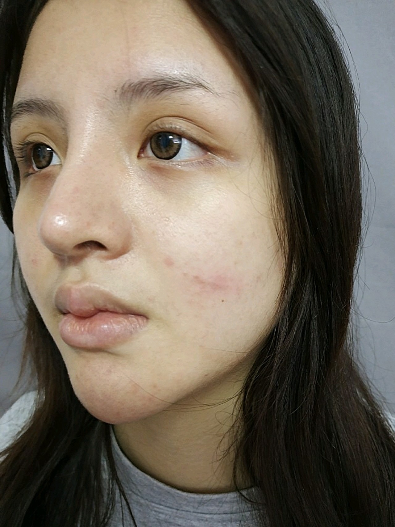 祛疤治疗63天的变化现在再看脸上这个疤痕凹陷的组织基本恢复平整了