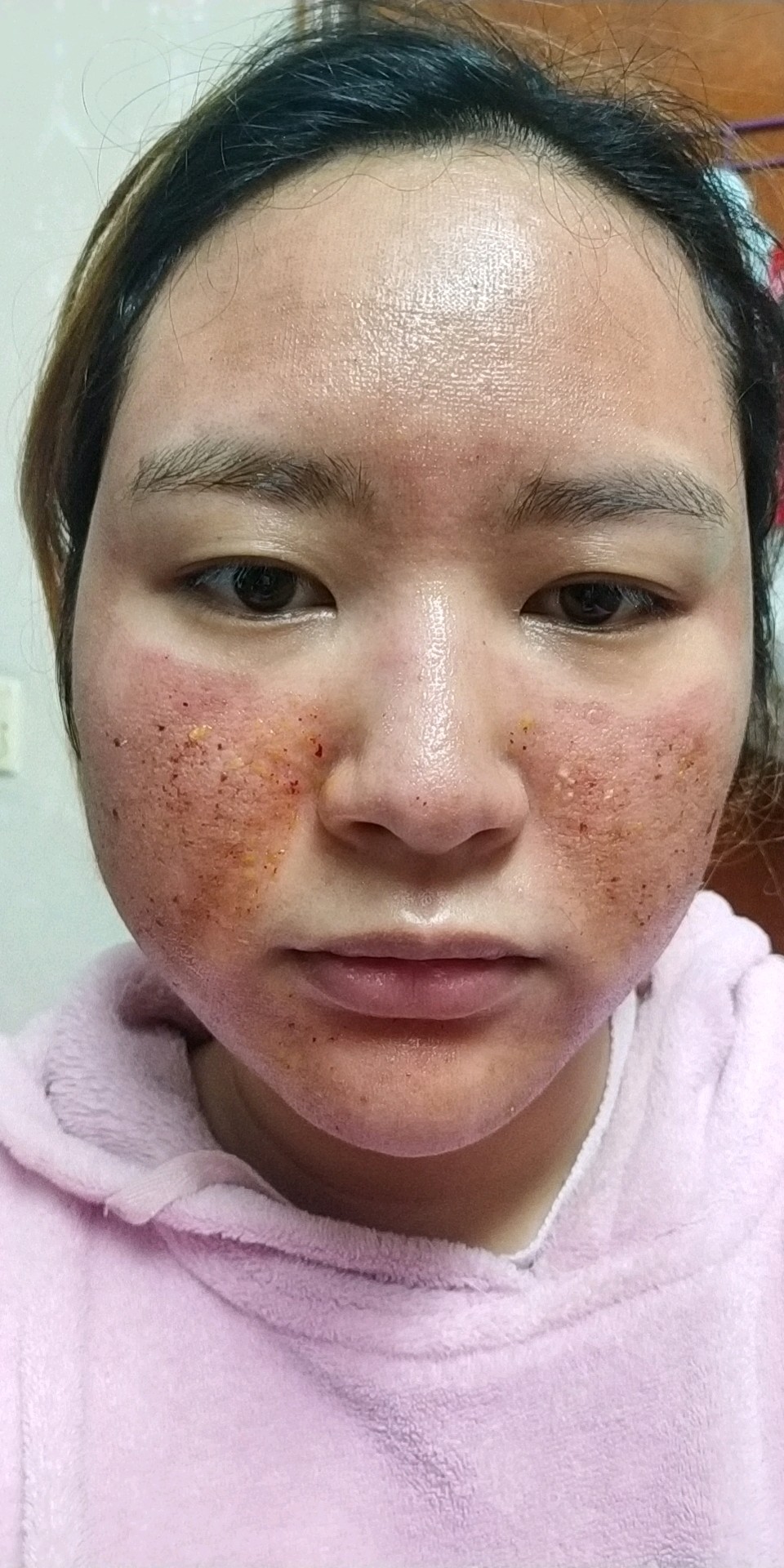 今天做点阵激光第一天,刚做完时有出血,流液,然后脸刺痛,火辣辣的的