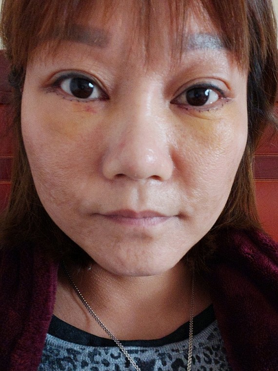 马上都要拆线了,恢复期还算没有什么炎症,就是下眼纹_圈子-新氧美容