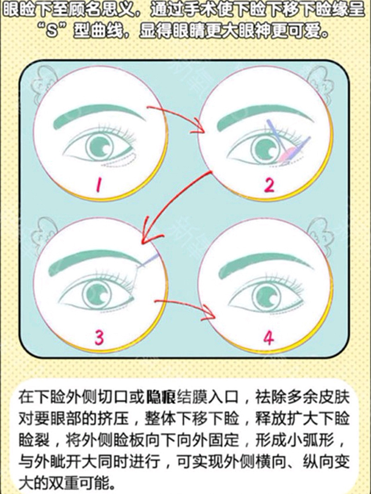 【你是否需要上睑提肌】