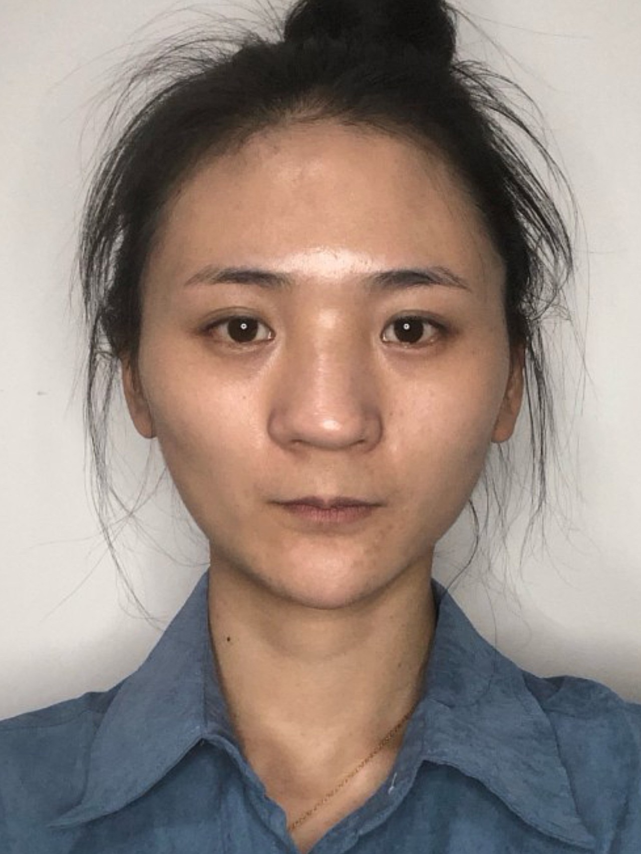 从 赵玉洁 的术前照,就能看出来,她是典型的蒜头鼻,山根低,鼻梁塌陷