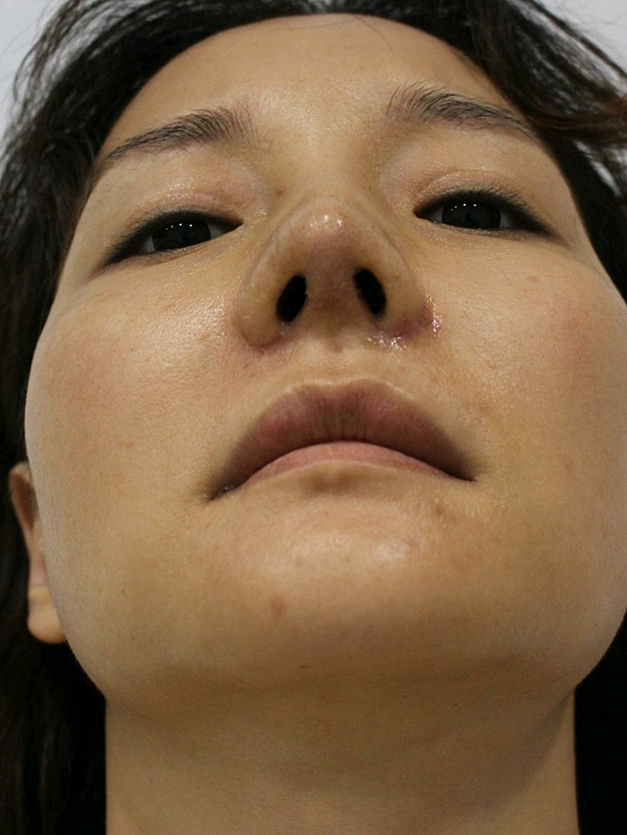 鼻修复 绿宝石医生 鼻中隔矫正术/歪鼻/肋骨/耳软骨