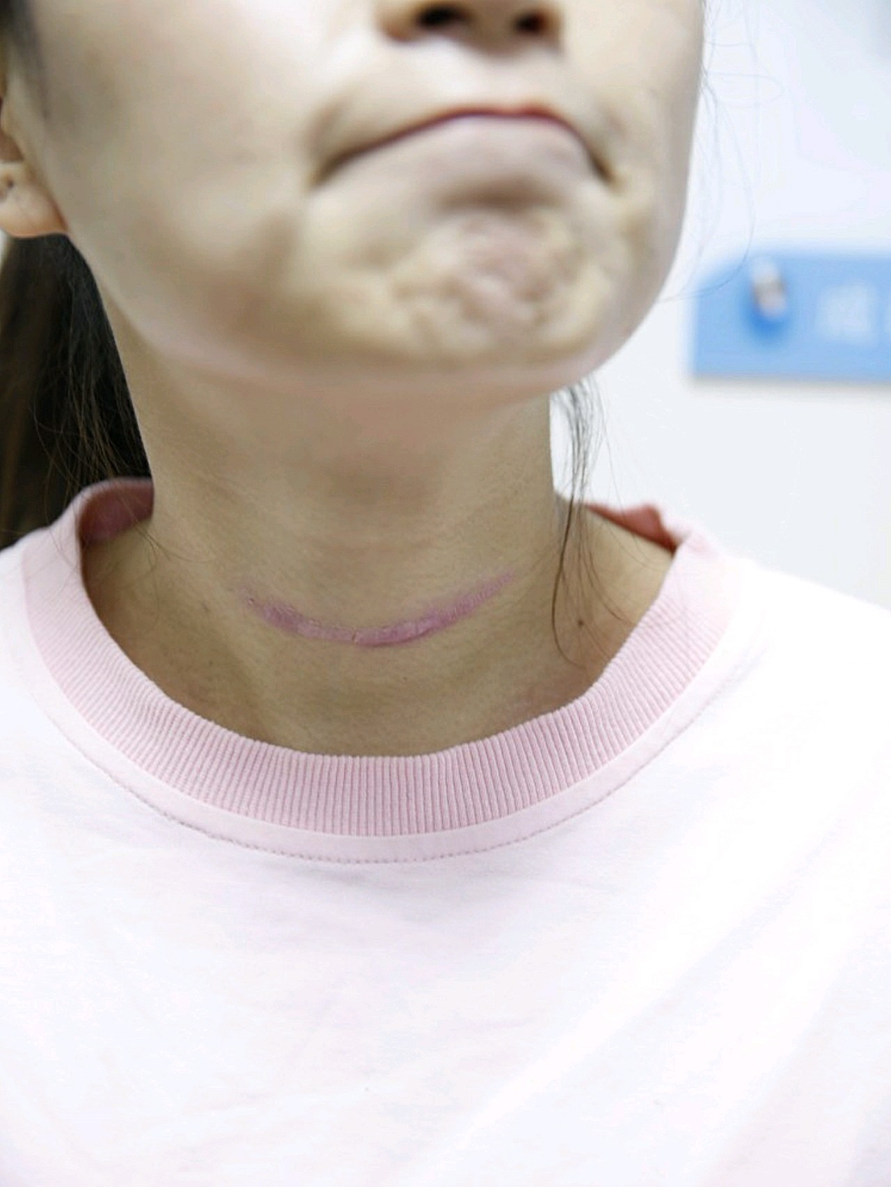 去年甲状腺手术留下的疤痕,原本就是一个切口的,后面_圈子-新氧美容