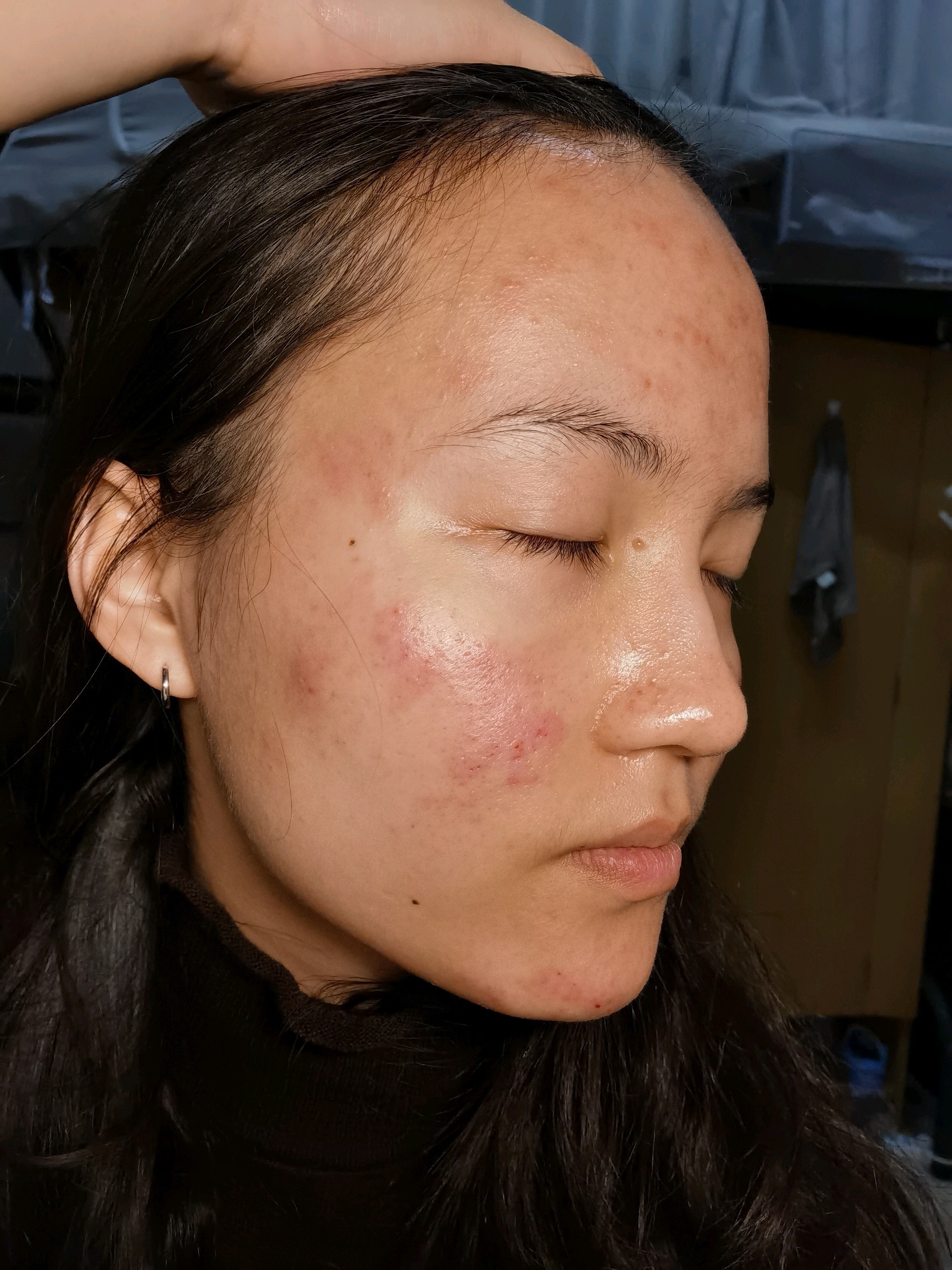 做了清痘的,红肿很严重,脸上有灼伤感,不过毛孔什么的干净了很多.