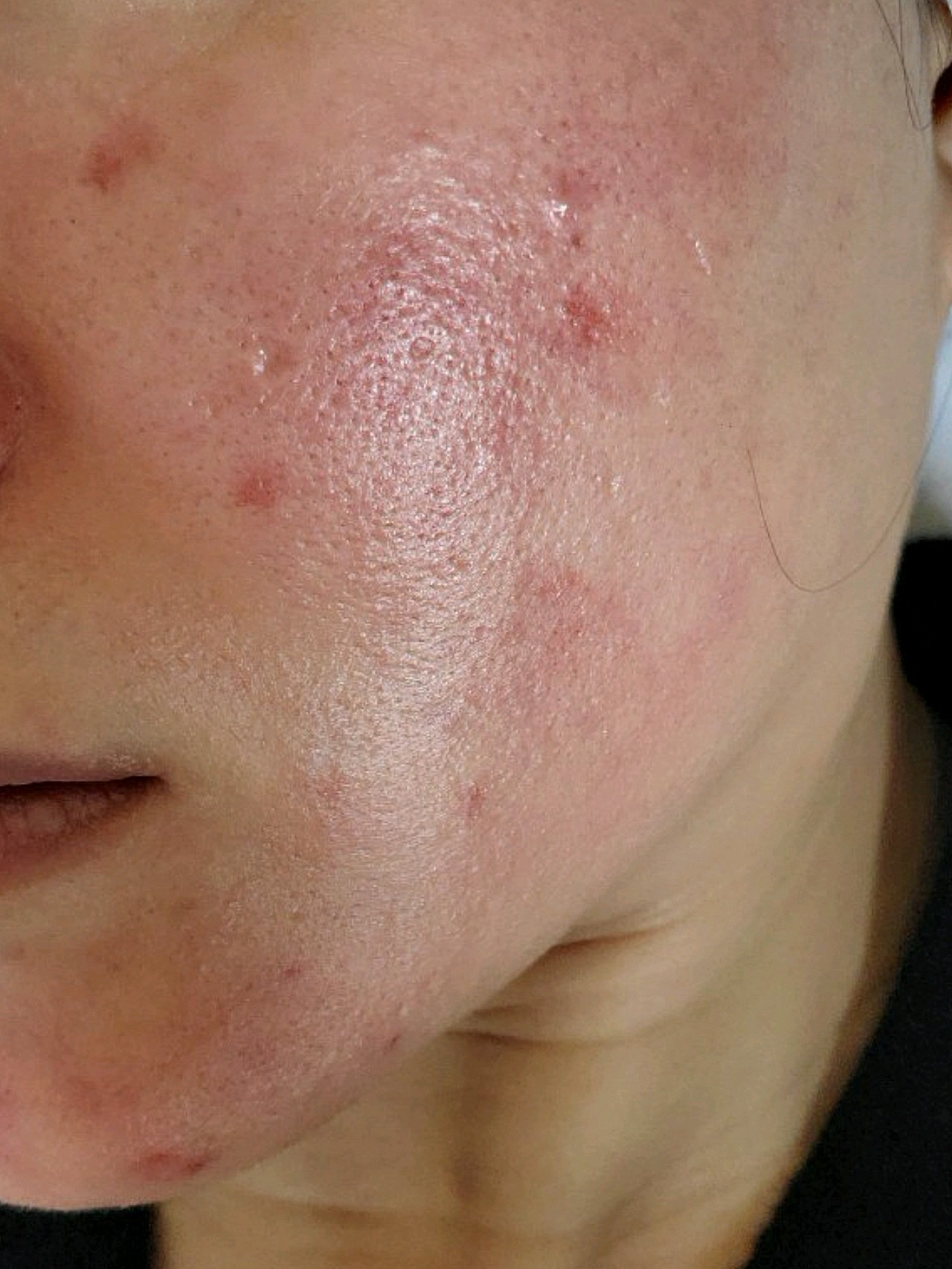 红蓝光祛痘第3天,做了红蓝光祛痘后,痘痘有了明显的_圈子-新氧美容