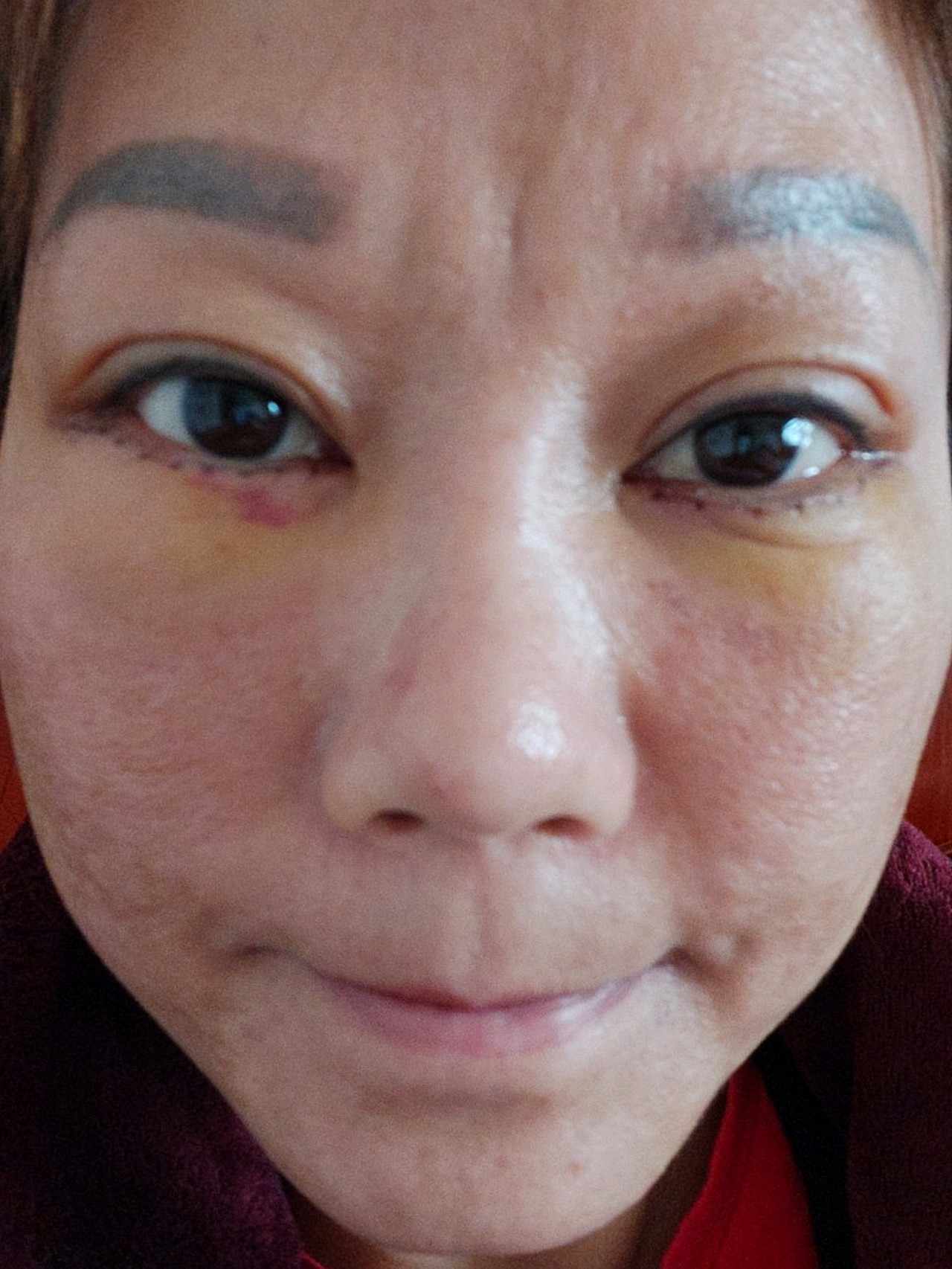外切眼袋手术还下线了,我这就是他们的外切眼袋手术,_圈子-新氧美容