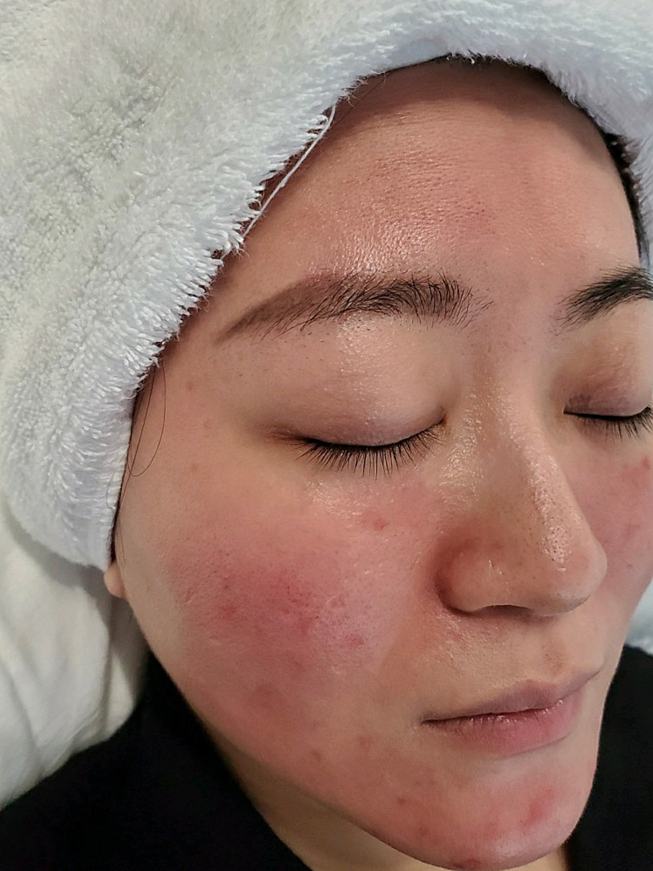 红蓝光祛痘第3天,做了红蓝光祛痘后,痘痘有了明显的_圈子-新氧美容