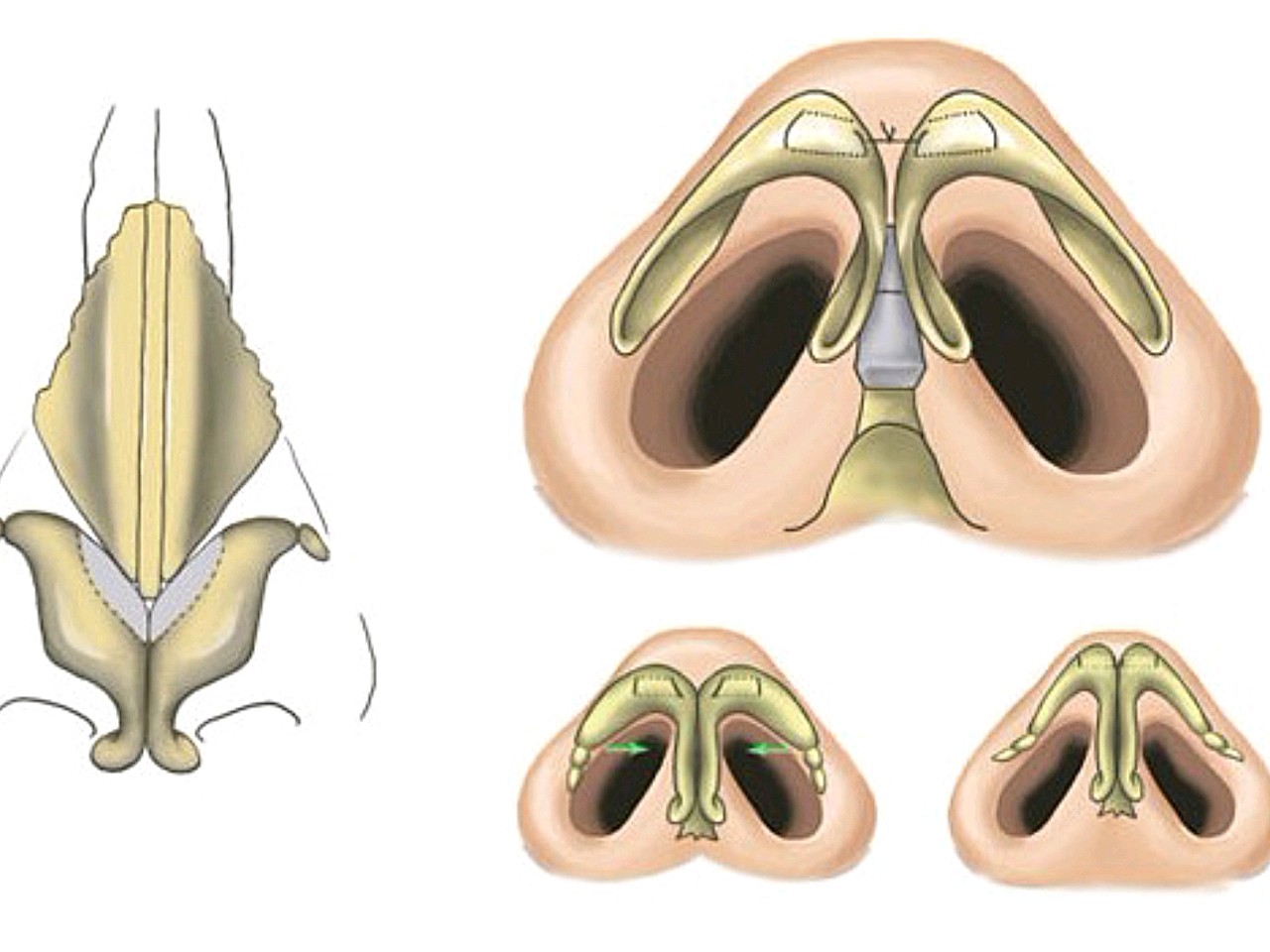 宽鼻缩窄术是一种通过重建鼻骨角度,既可改善高度