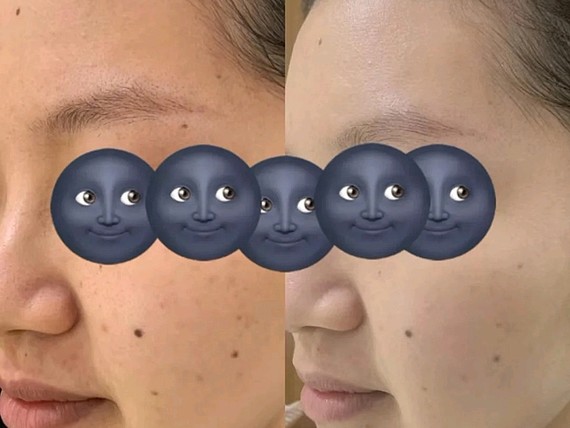 做了一直想做的光子嫩肤,除了第二天有点反黑,并没有_圈子-新氧美容