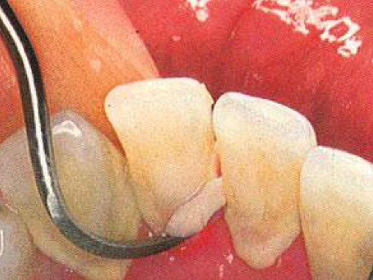 牙结石是牢固黏附在牙齿表面的硬质异物,是在牙垢,牙_圈子-新氧美容