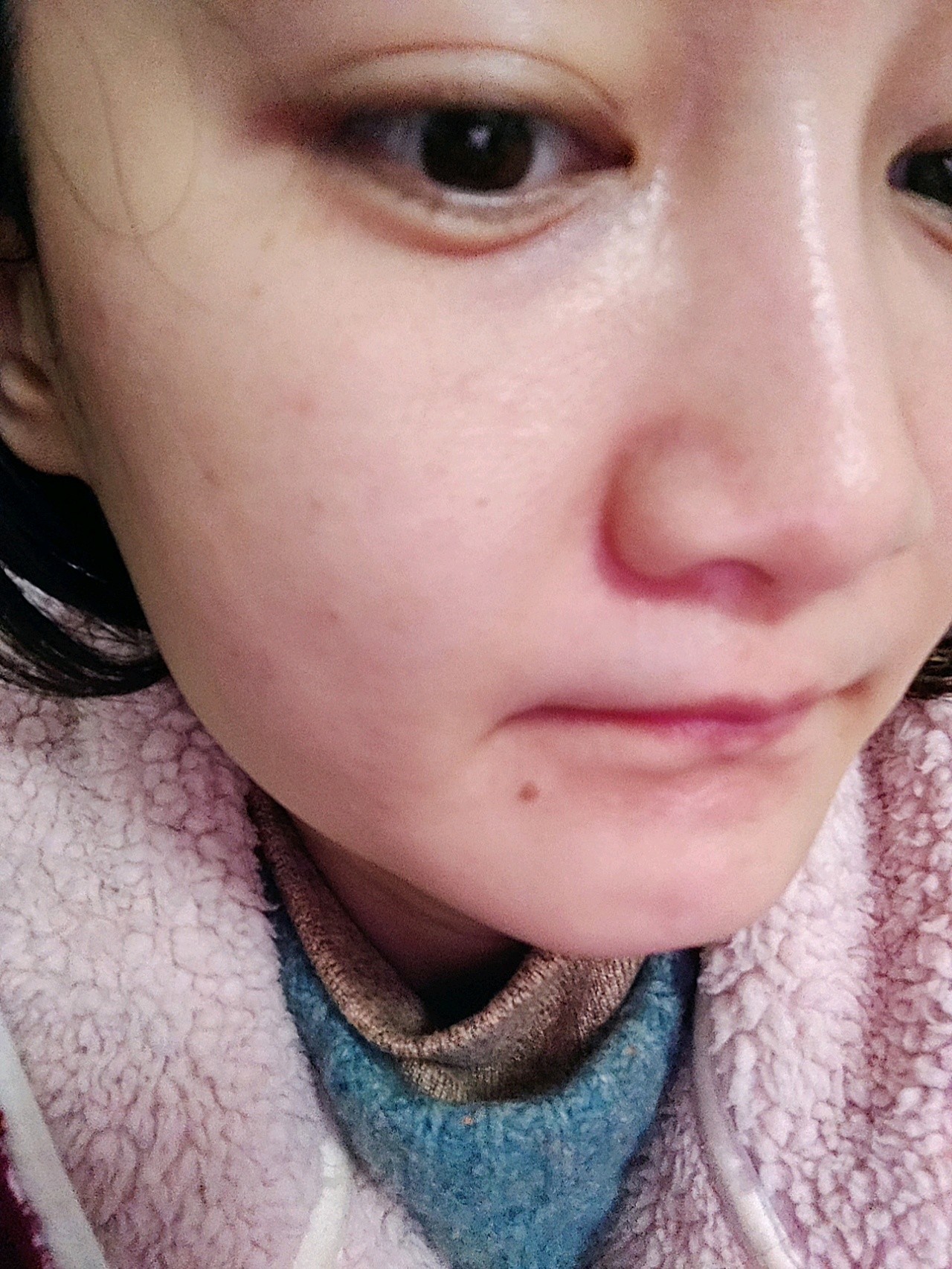 做为新氧体验官做完博乐达水杨酸焕肤的第二天最明显的感受就是之前